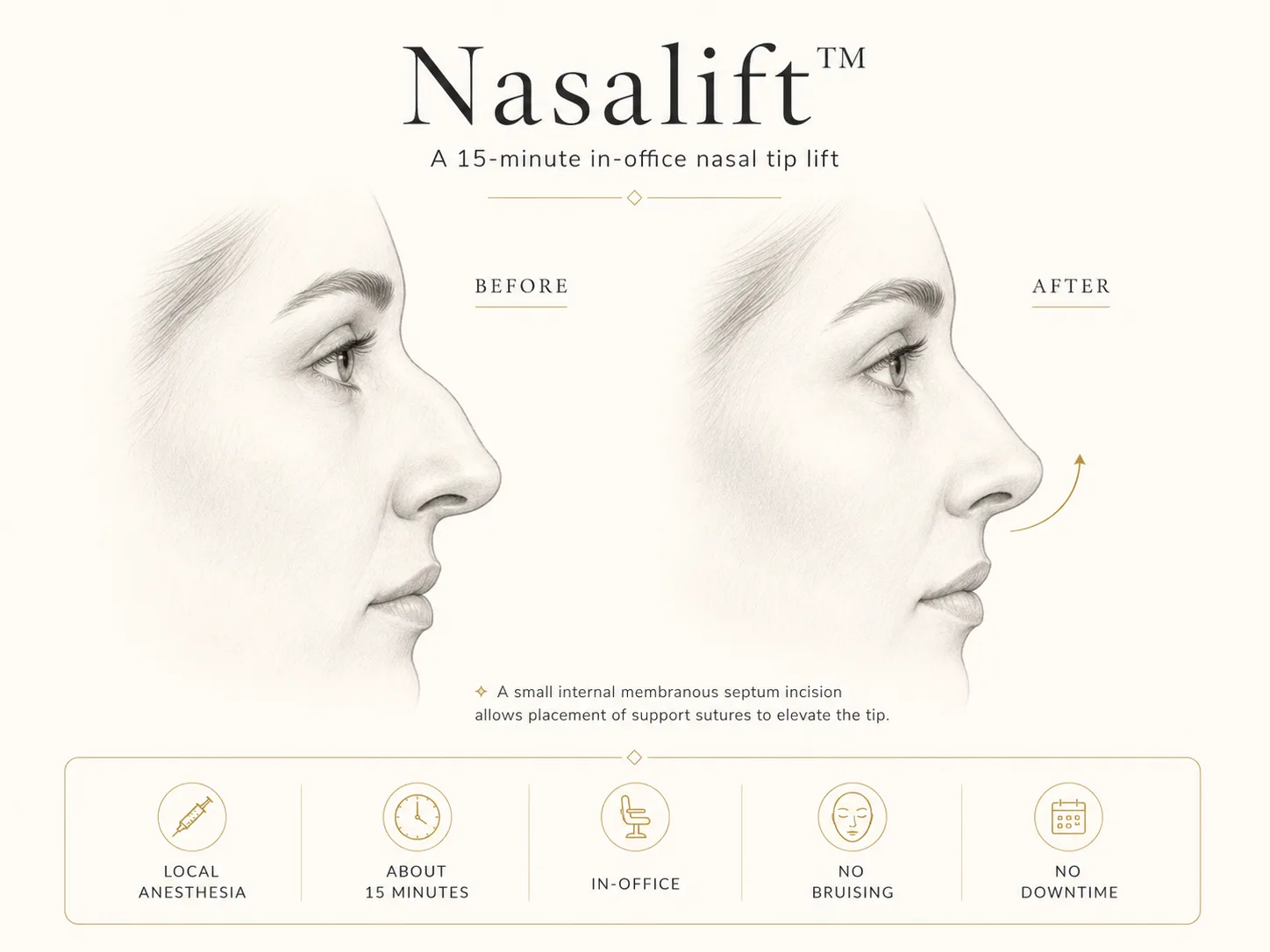 Before-and-after medical illustration of Nasalift showing subtle elevation of a drooping nasal tip and improved balance between the tip and dorsal profile.