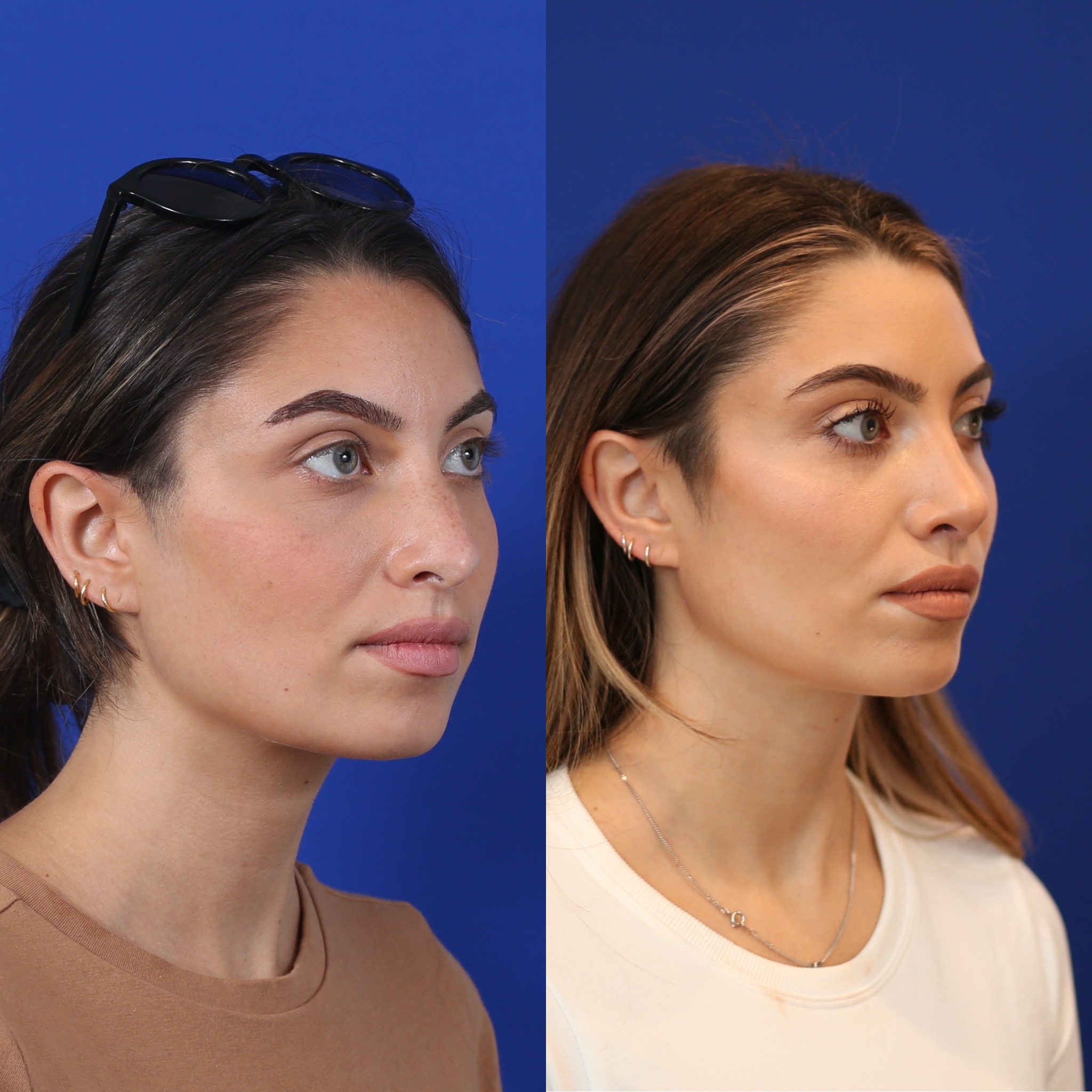 Left three-quarter comparison before and after primary rhinoplasty