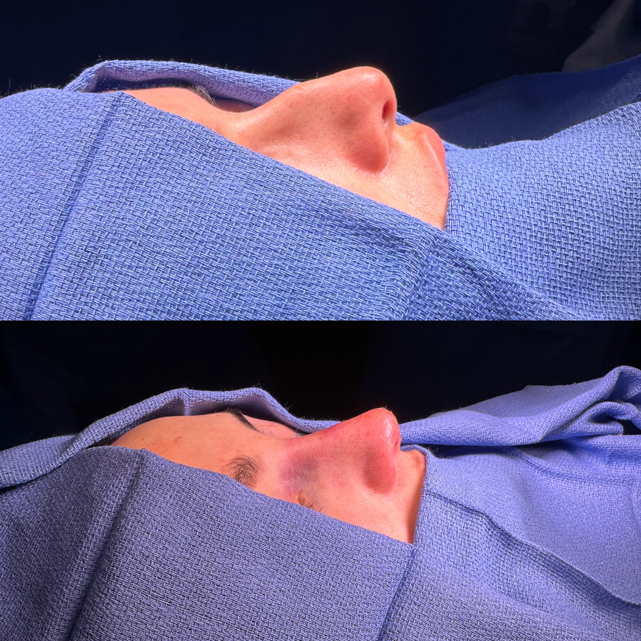 Intra-operative basal view of the nose during primary rhinoplasty showing tip refinement at two stages