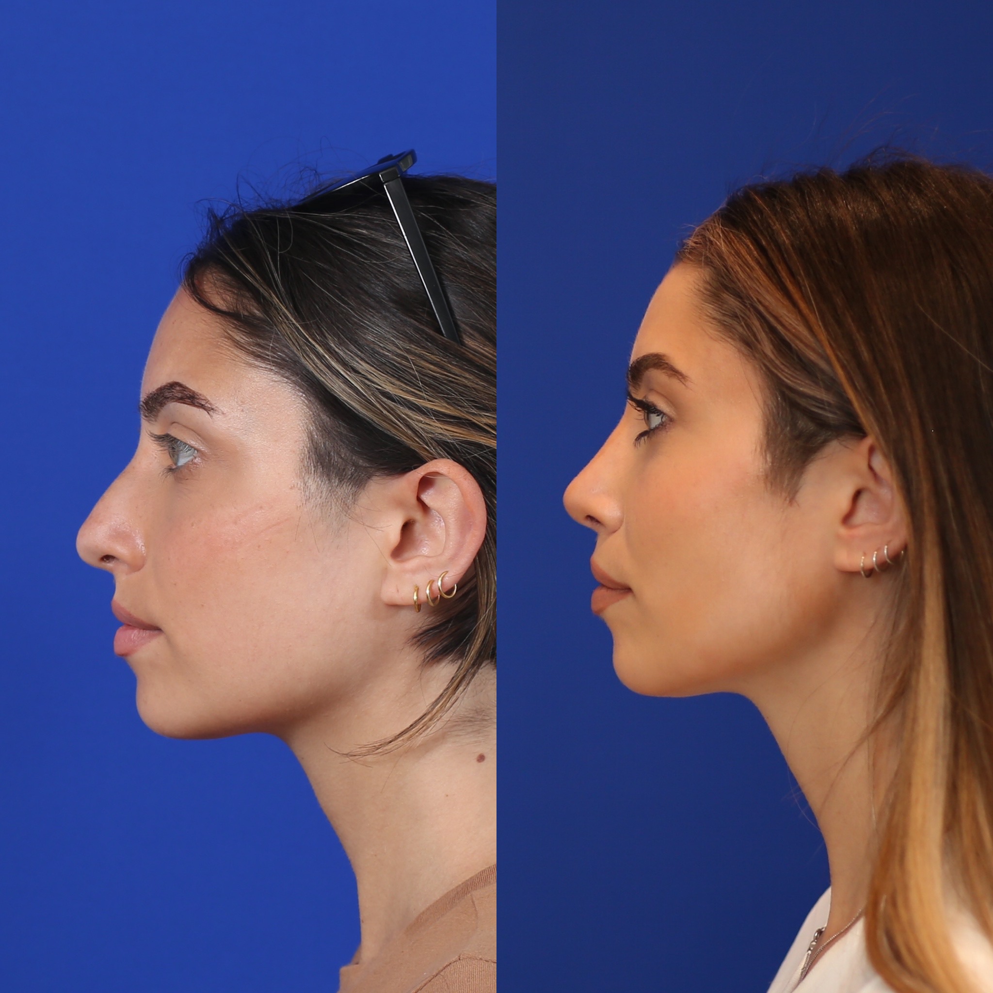 Right lateral profile comparison before and after primary rhinoplasty