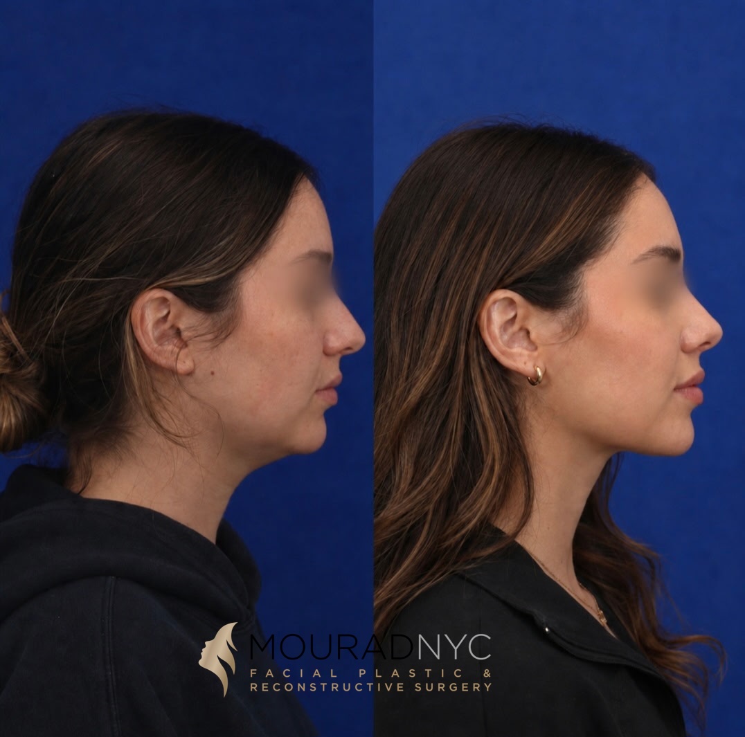 Right lateral profile comparison of a female patient in her 20s before and after chin implant and neck lift
