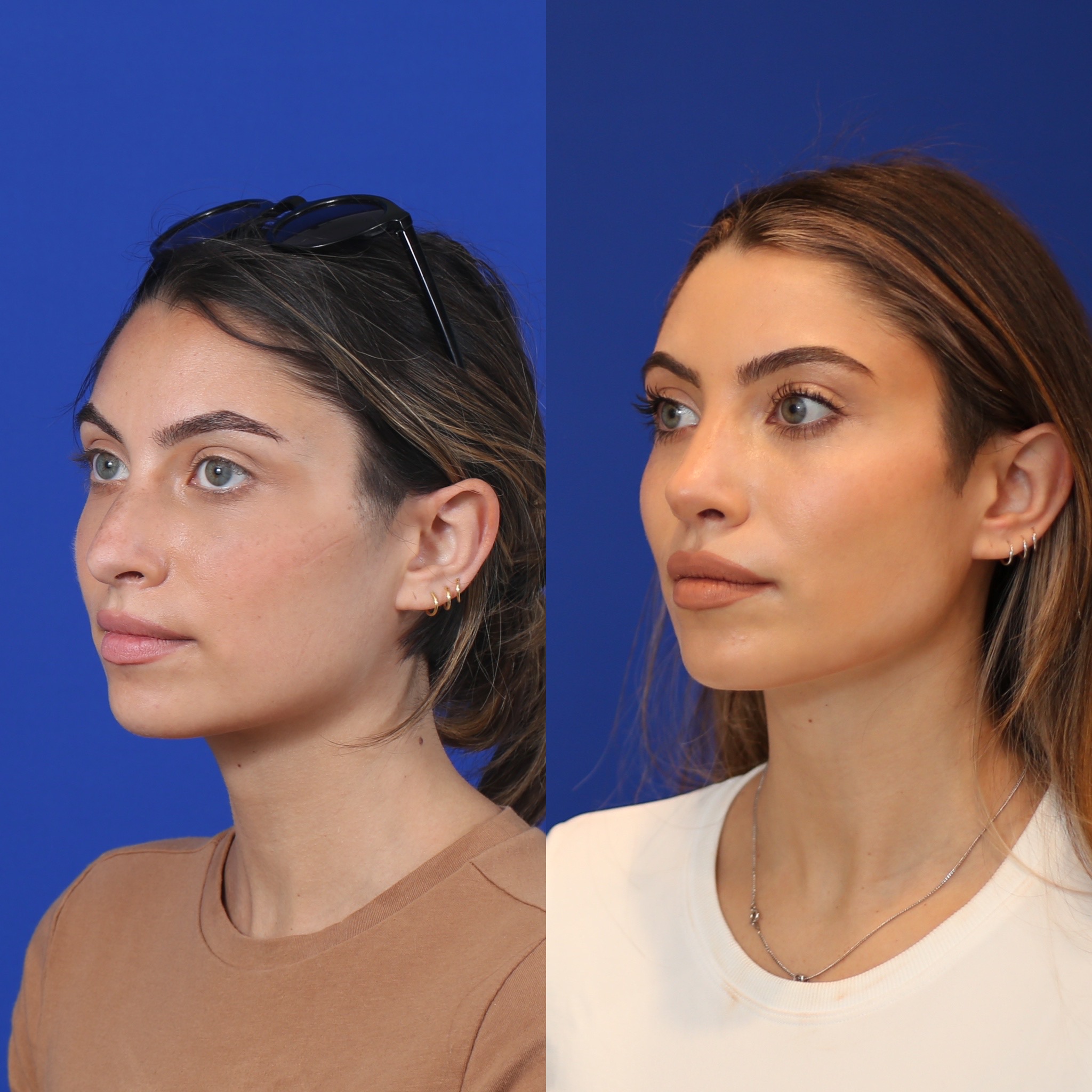 Right three-quarter comparison before and after primary rhinoplasty