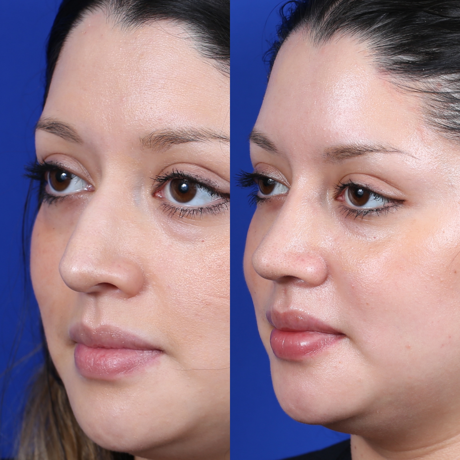 Left three-quarter comparison of female patient in her 20s before and after primary rhinoplasty