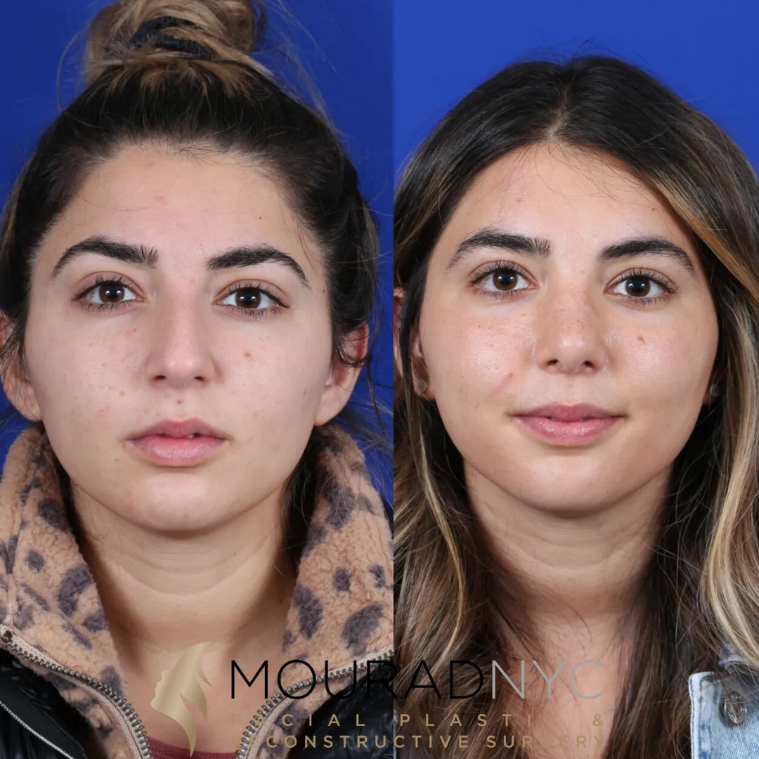 Frontal comparison of female patient in her 20s before and after septorhinoplasty with rib graft and sinus surgery