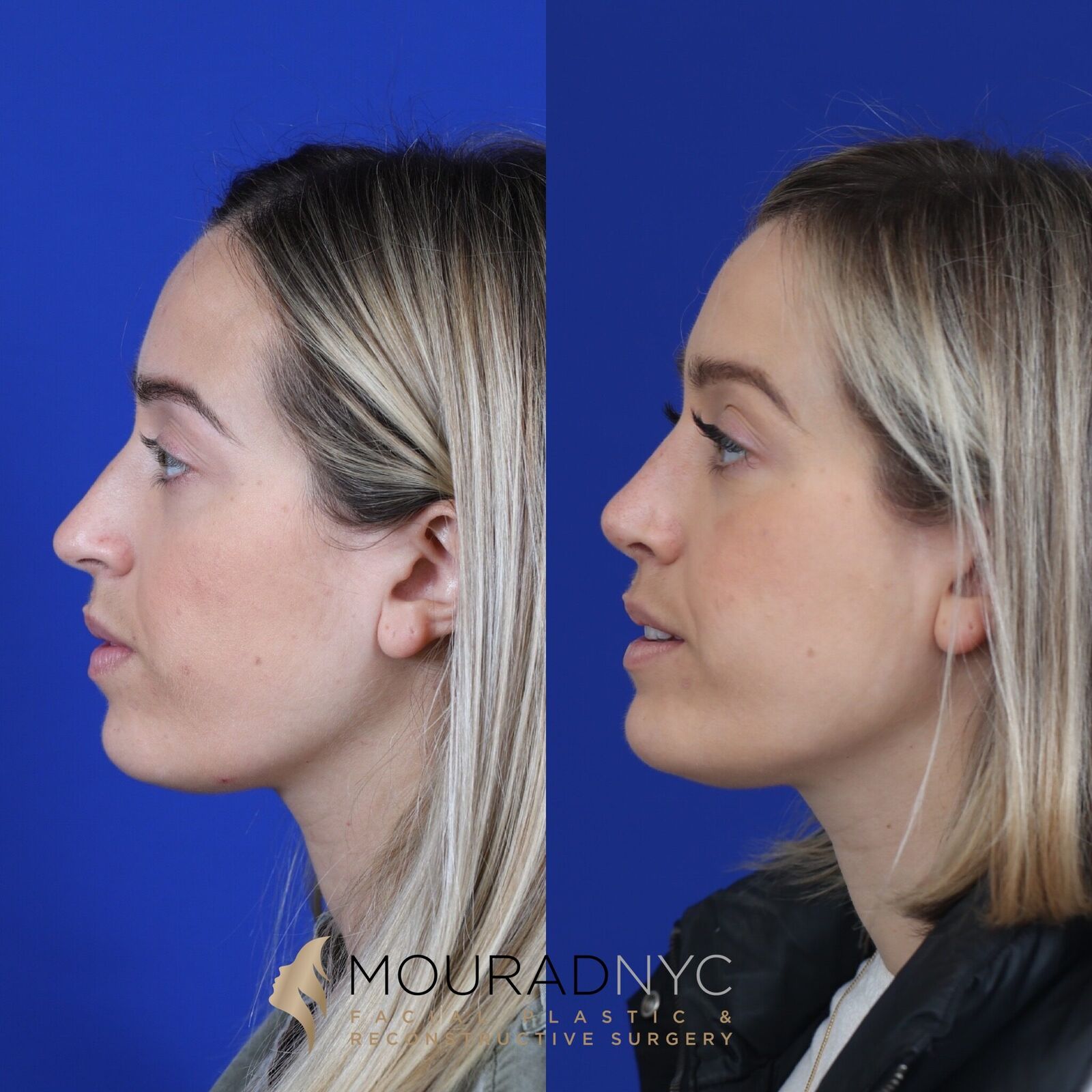 Right lateral profile comparison of female patient in her 30s before and after primary rhinoplasty