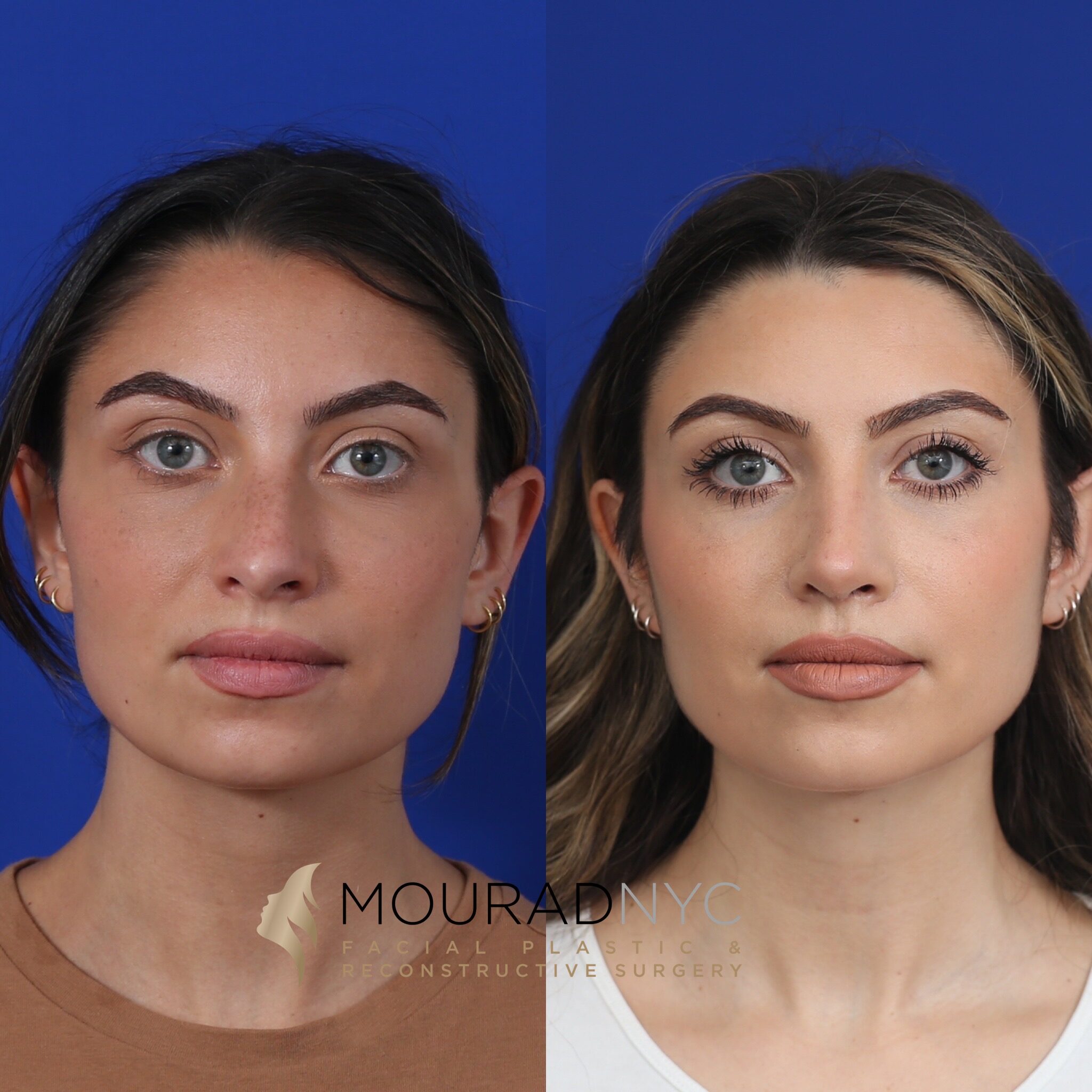 Frontal comparison before and after primary rhinoplasty