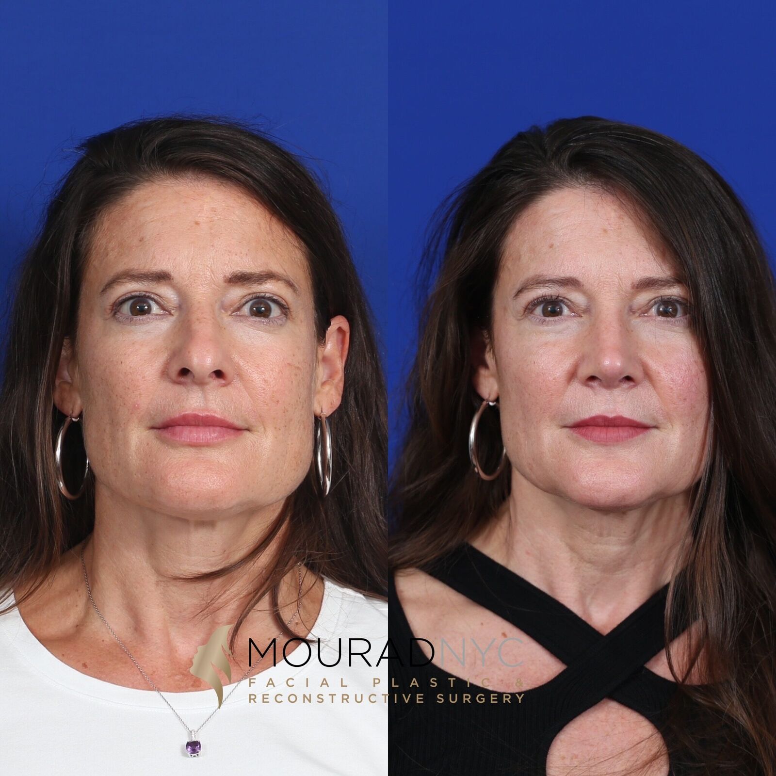 Frontal comparison of female patient in her 40s before and after primary rhinoplasty with sinus surgery