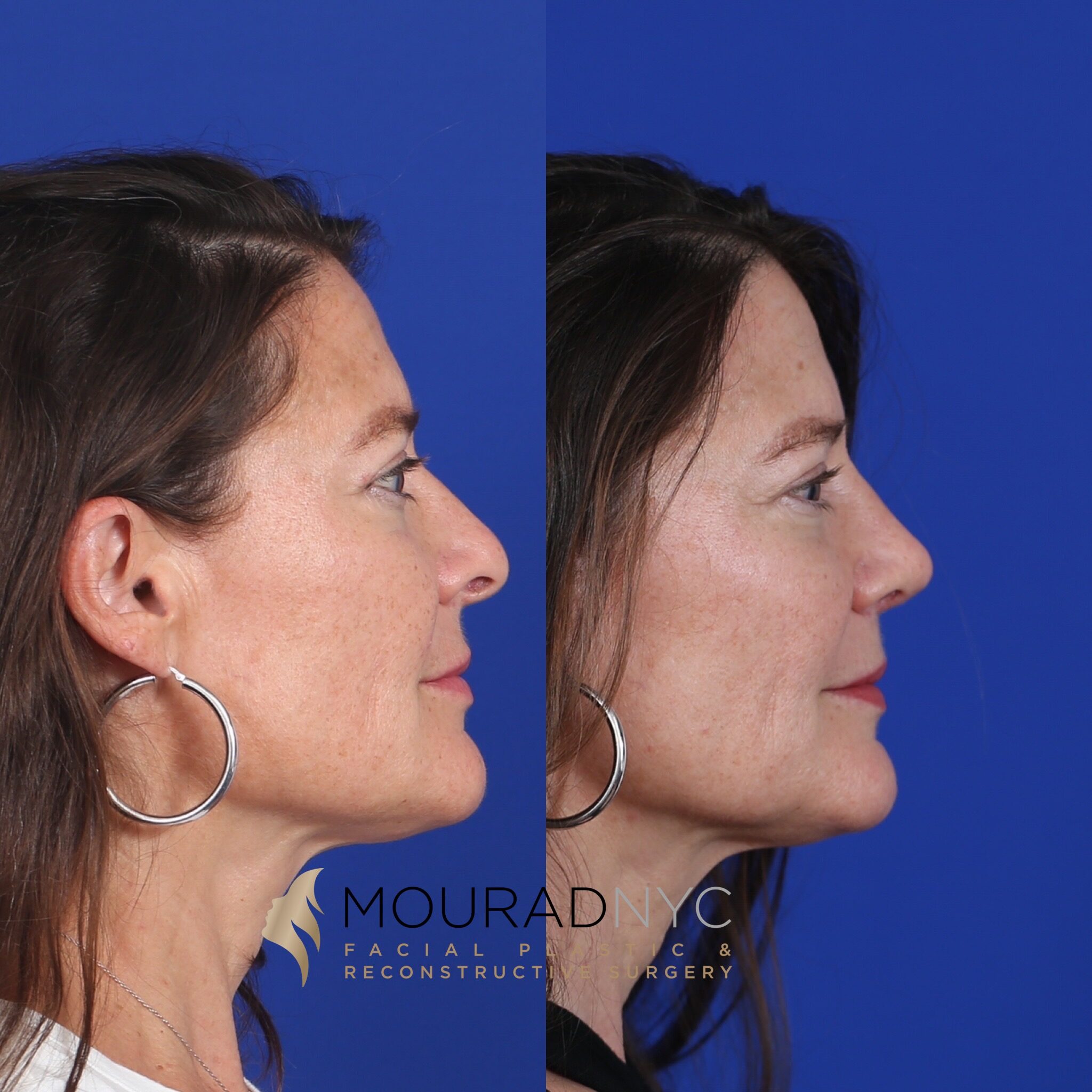 Left lateral profile comparison before and after primary rhinoplasty