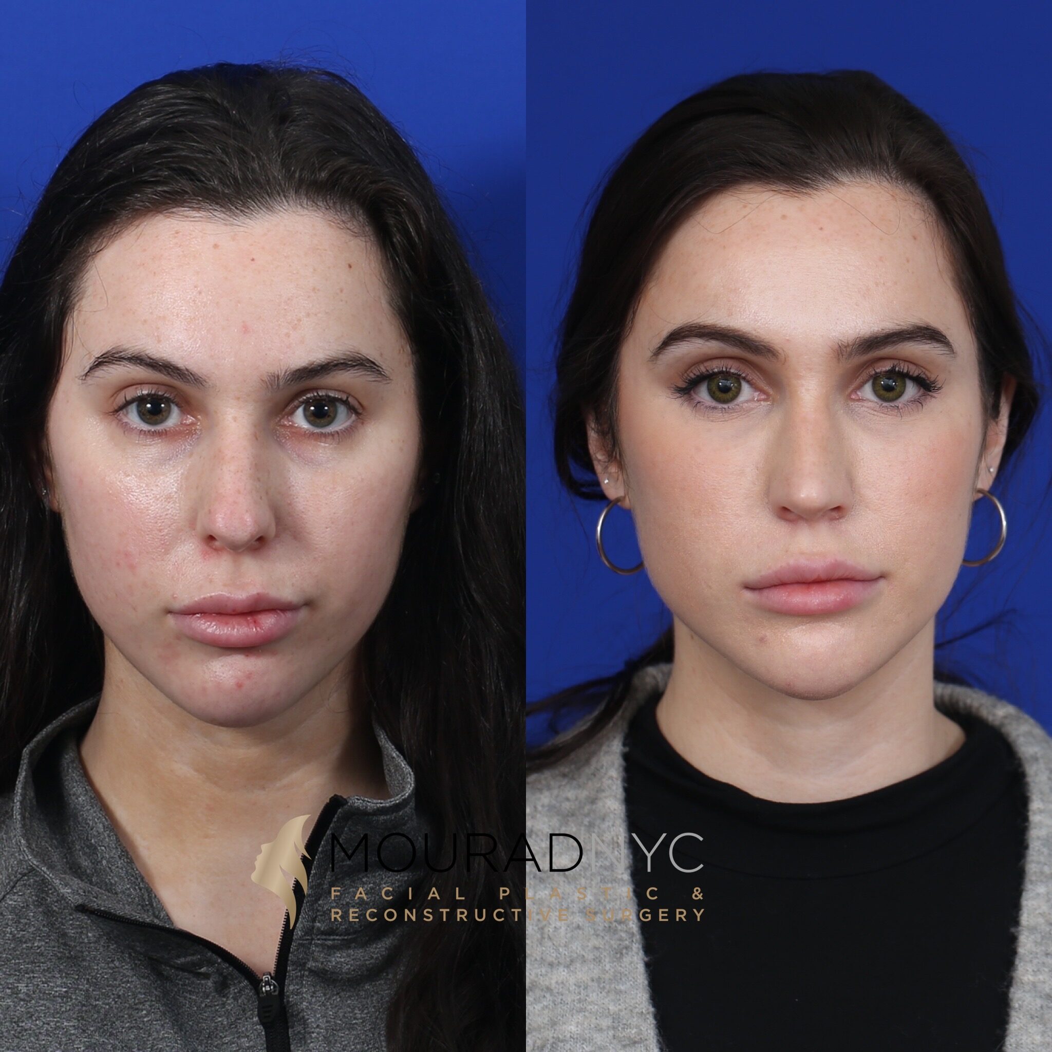 Frontal comparison of female patient in her 20s before and after primary rhinoplasty