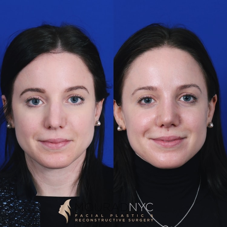 Frontal comparison of female patient in her 20s before and after septorhinoplasty with rib graft and broken nose repair