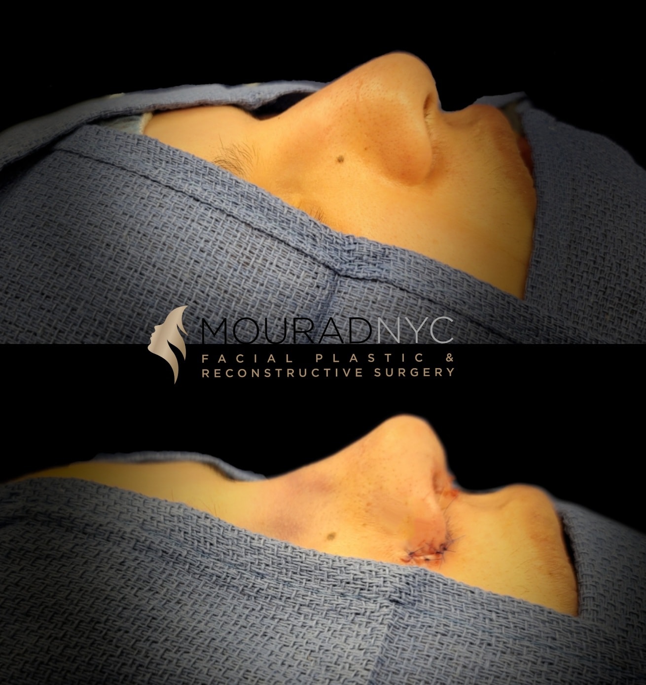 Intra-operative basal view of the nose during primary rhinoplasty showing tip and nostril contour with columellar closure at two stages