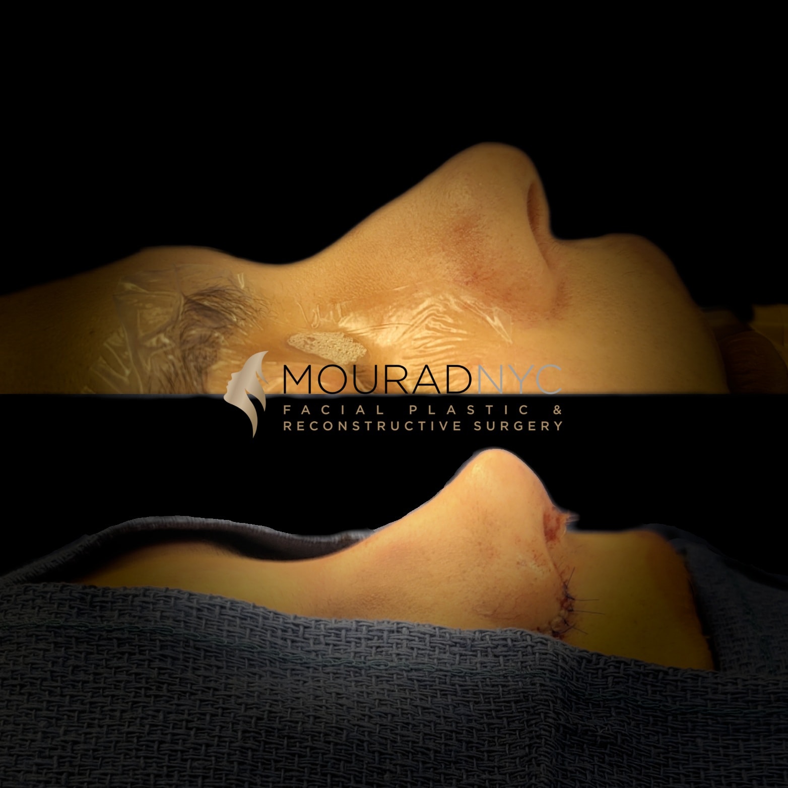 Intra-operative views of the nose during primary rhinoplasty showing open exposure and columellar closure stages