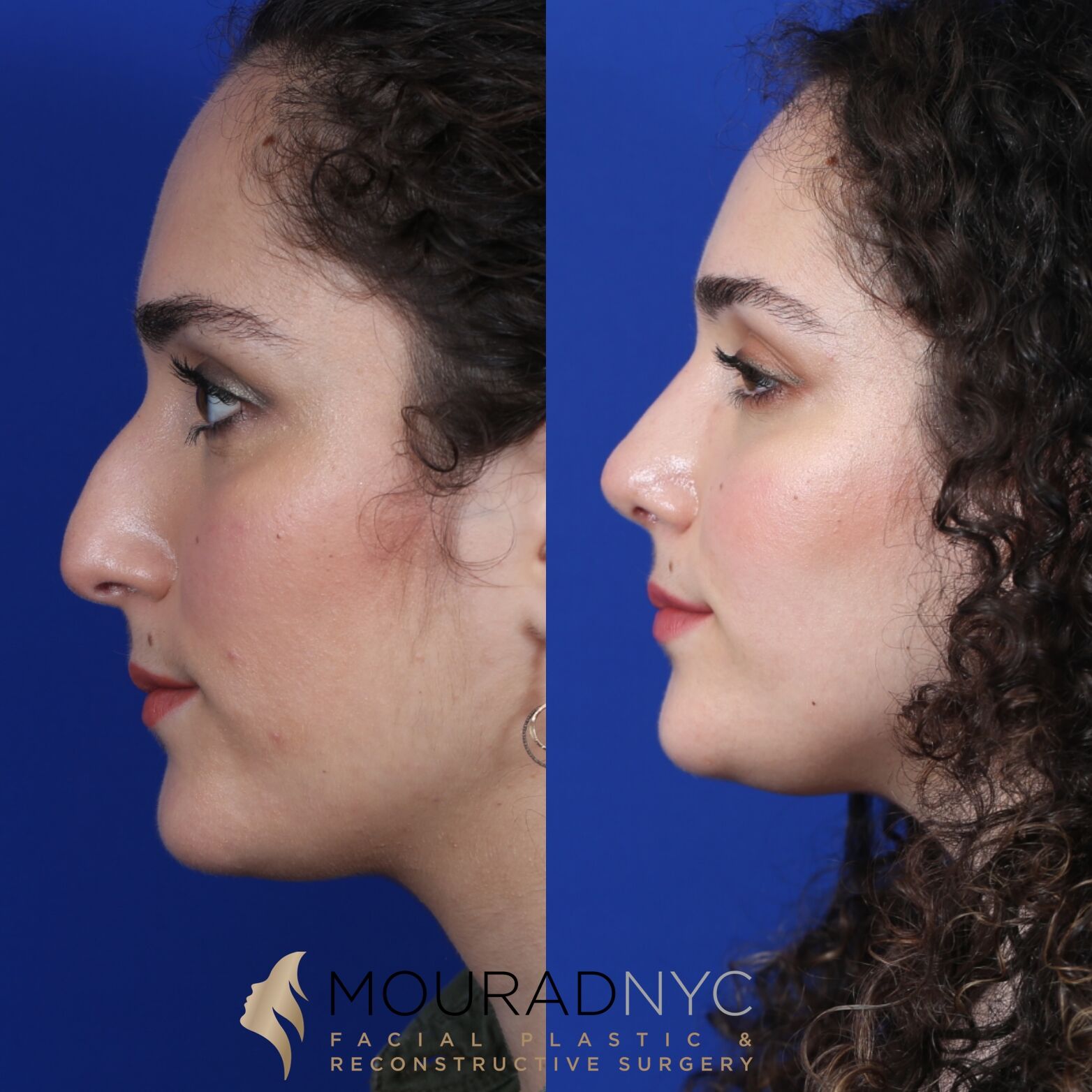 Right lateral profile comparison of female patient in her 20s before and after septorhinoplasty with sinus surgery