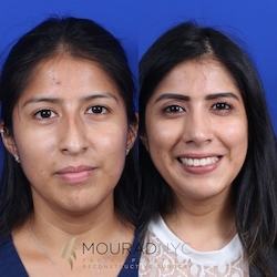 Frontal comparison of female patient in her 30s before and after primary rhinoplasty with septoplasty and broken nose repair