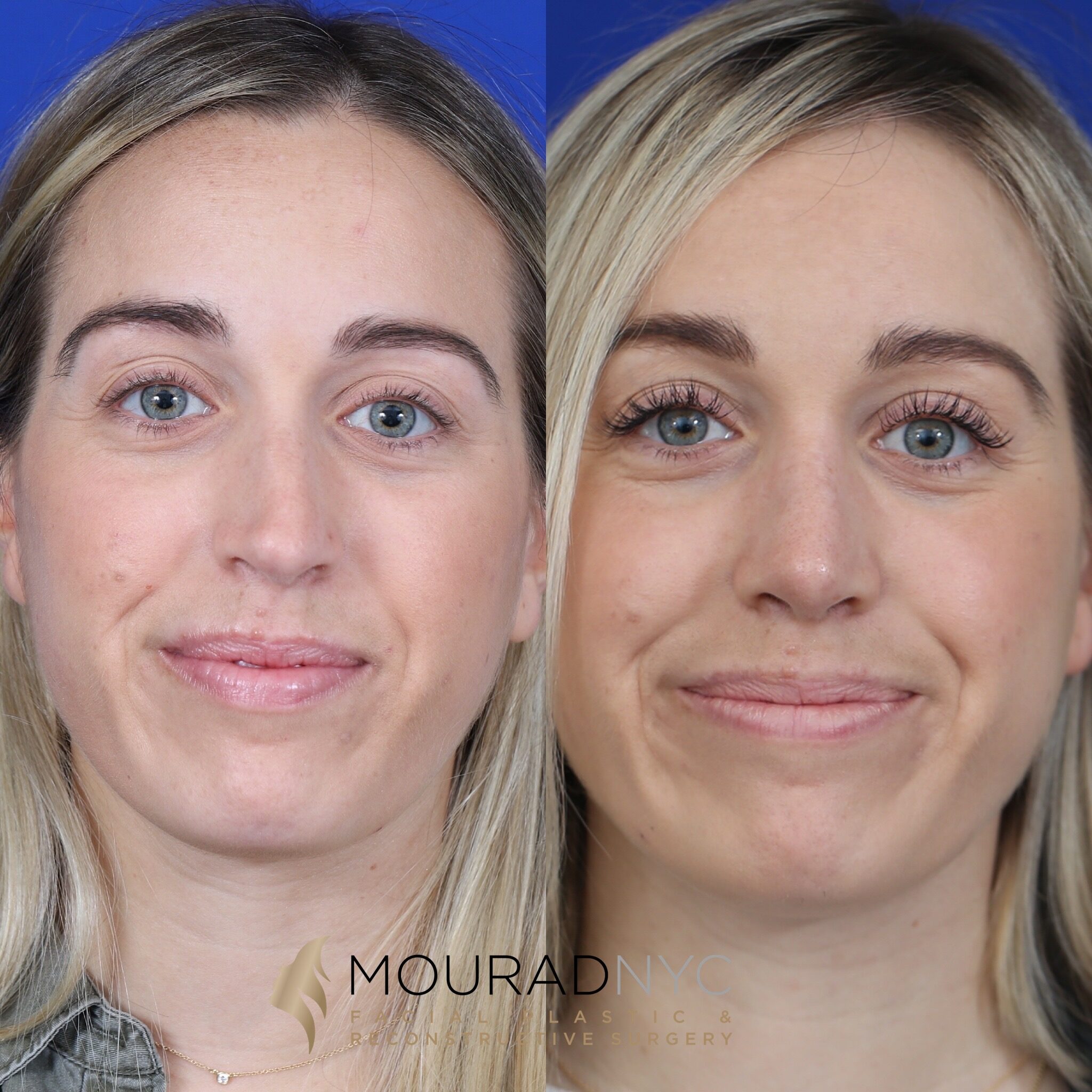 Frontal view comparison of female patient in her 30s before and after primary rhinoplasty