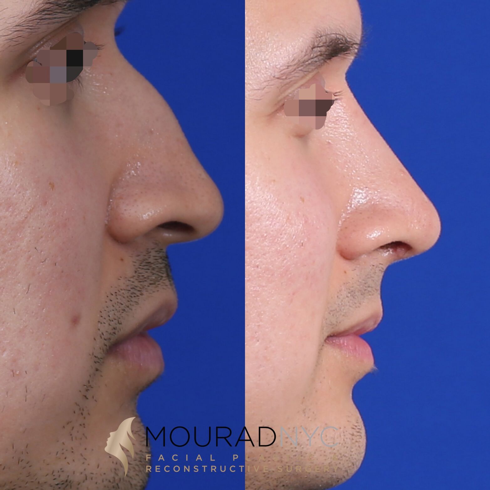 Right lateral profile comparison of male patient in his 30s before and after revision rhinoplasty with rib graft