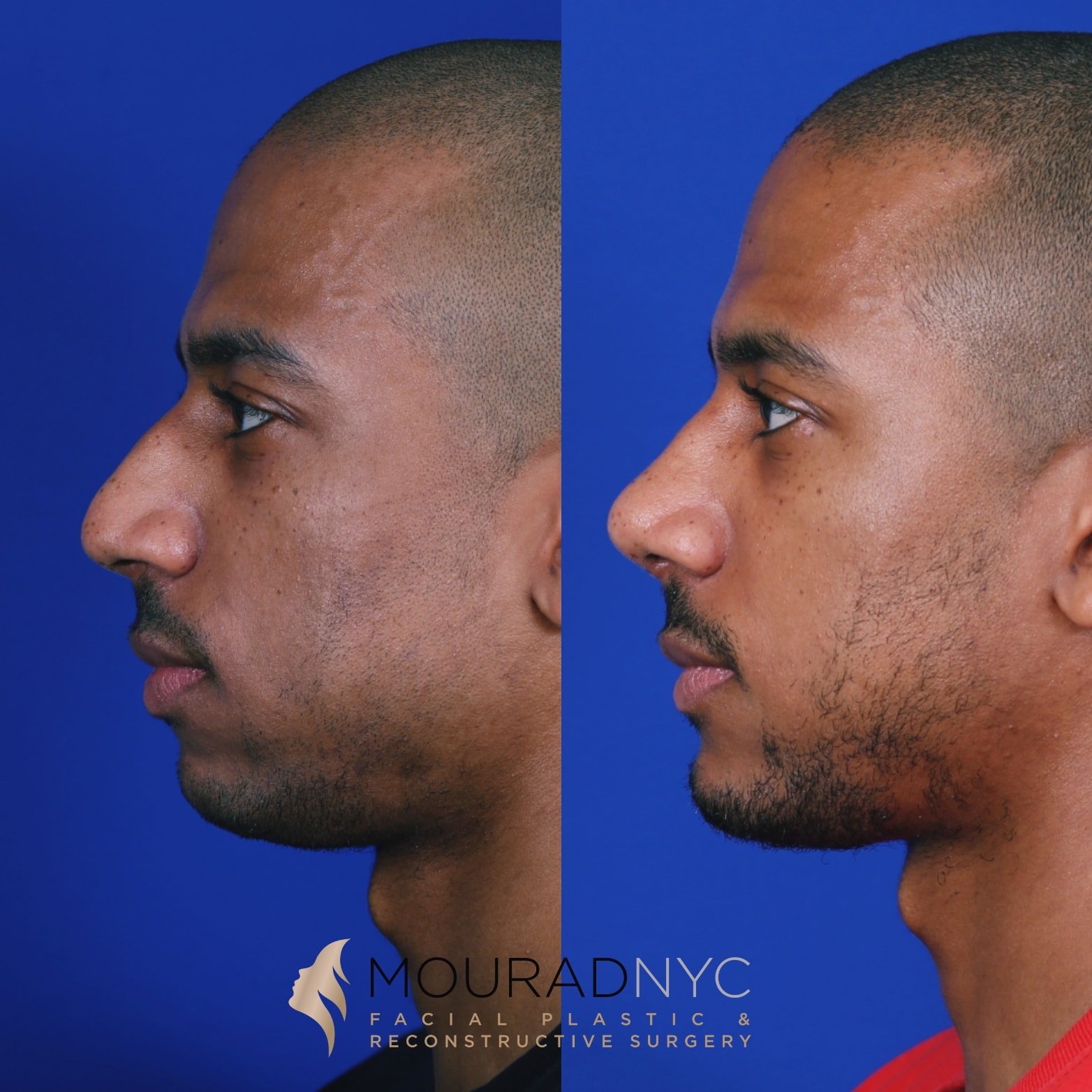 Right lateral profile comparison of male patient in his 20s before and after primary rhinoplasty with sliding genioplasty