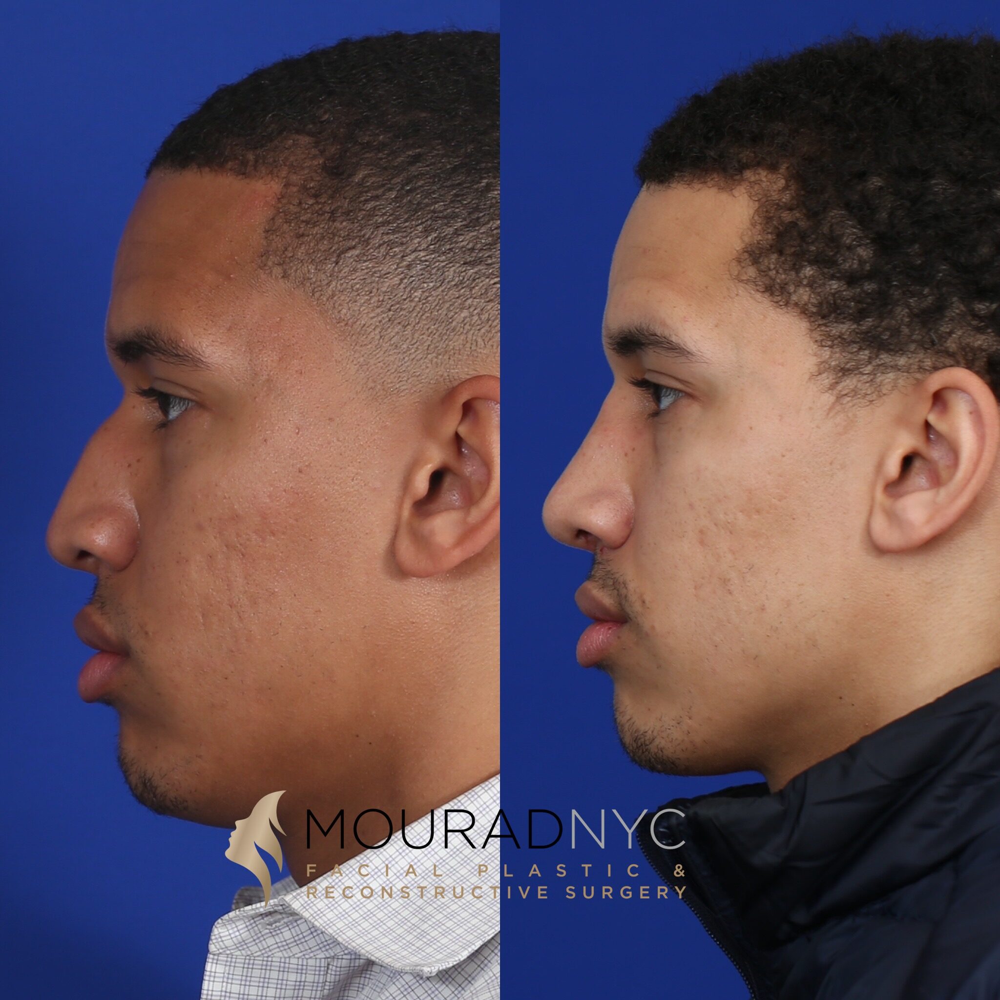 Left lateral profile comparison before and after ethnic rhinoplasty