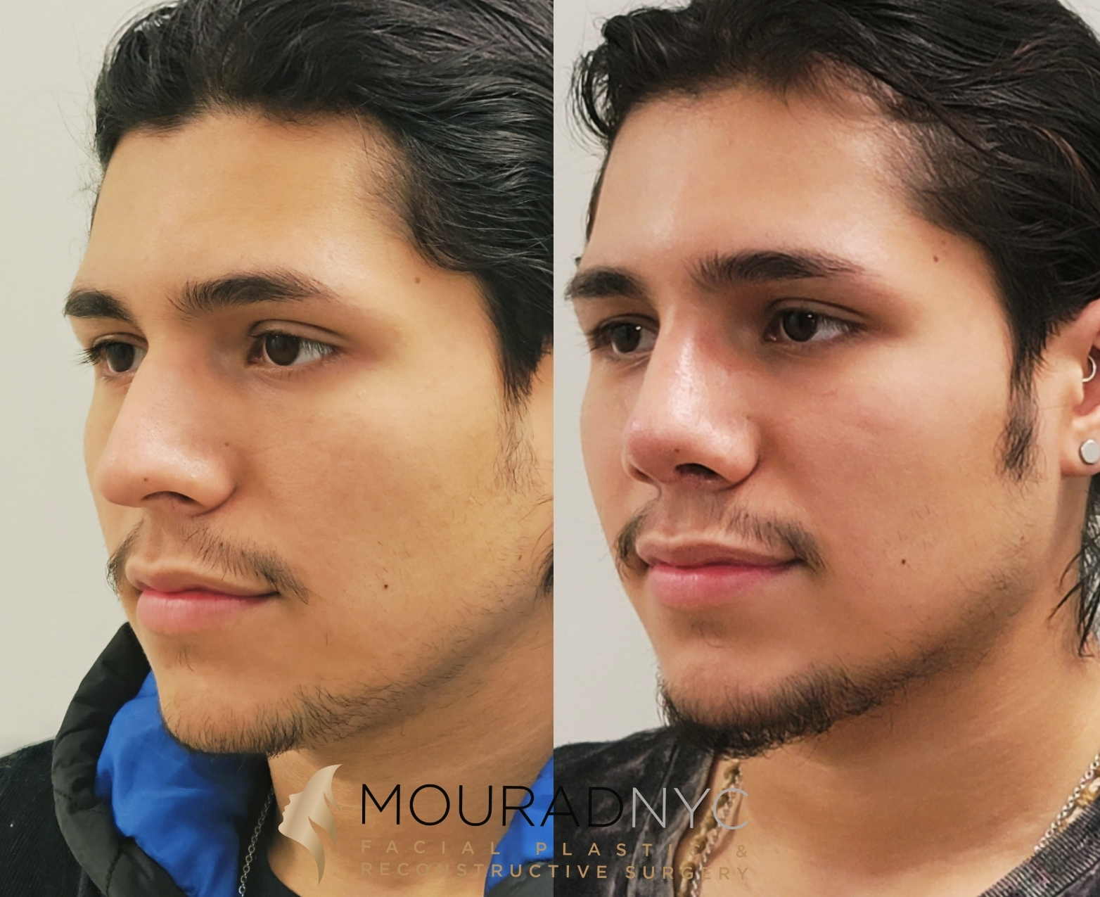 Right three-quarter comparison of male patient in his 20s before and after ethnic rhinoplasty