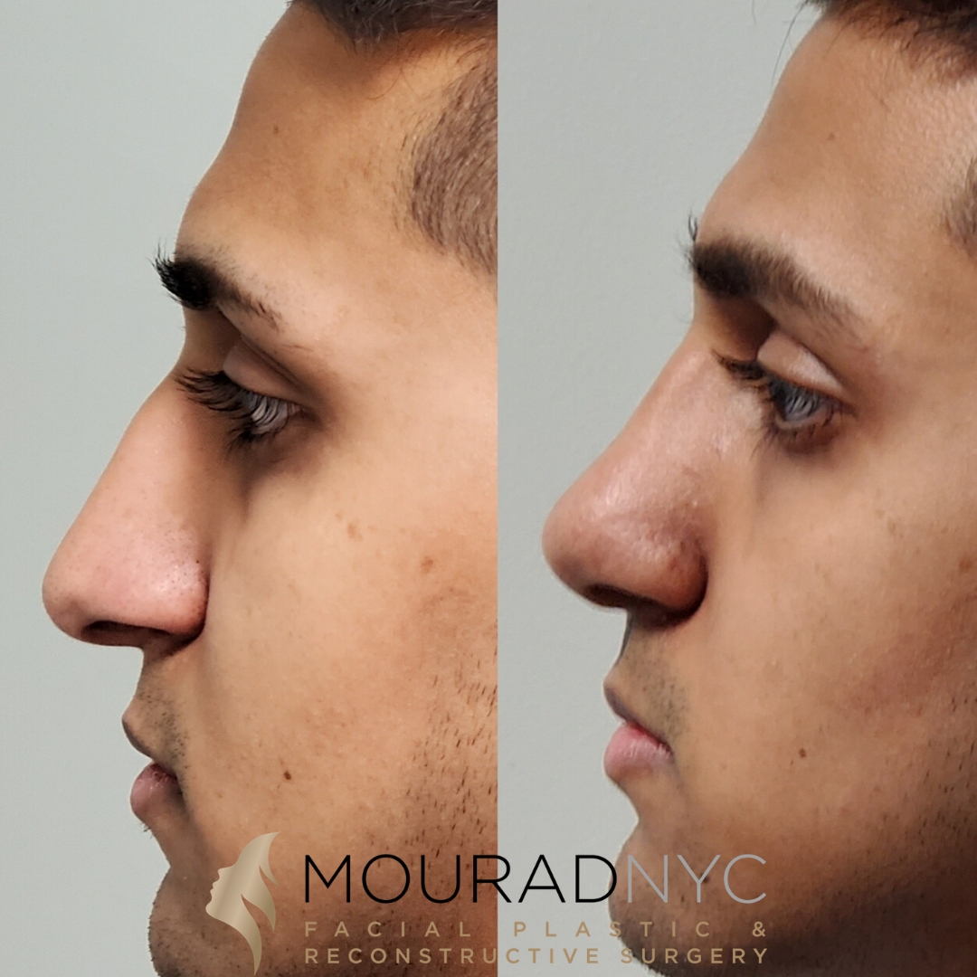 Right lateral profile comparison of male patient in his 20s before and after revision rhinoplasty with rib graft