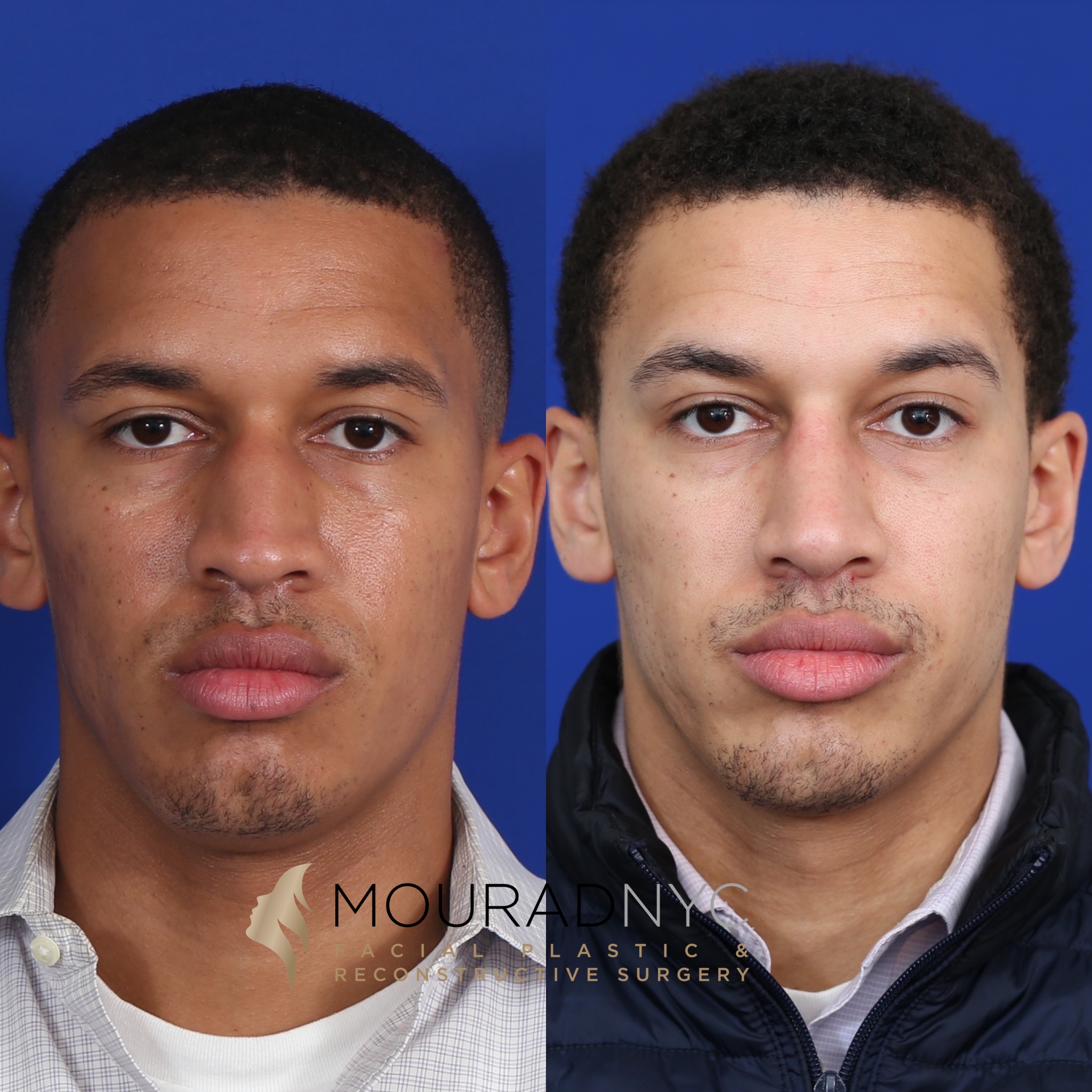 Frontal comparison before and after ethnic rhinoplasty