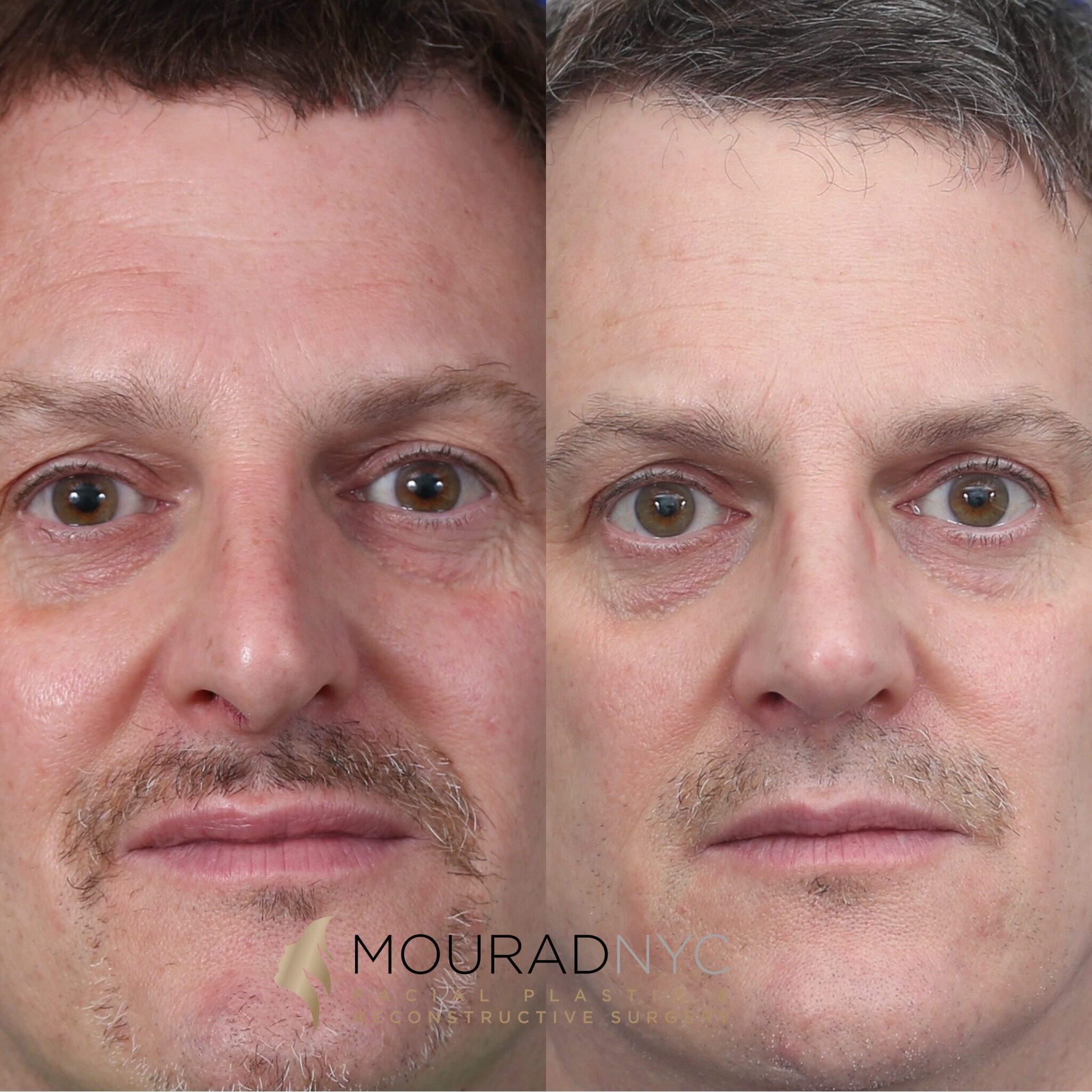 Frontal comparison of male patient in his 50s before and after septorhinoplasty with rib graft, septoplasty, and sinus surgery