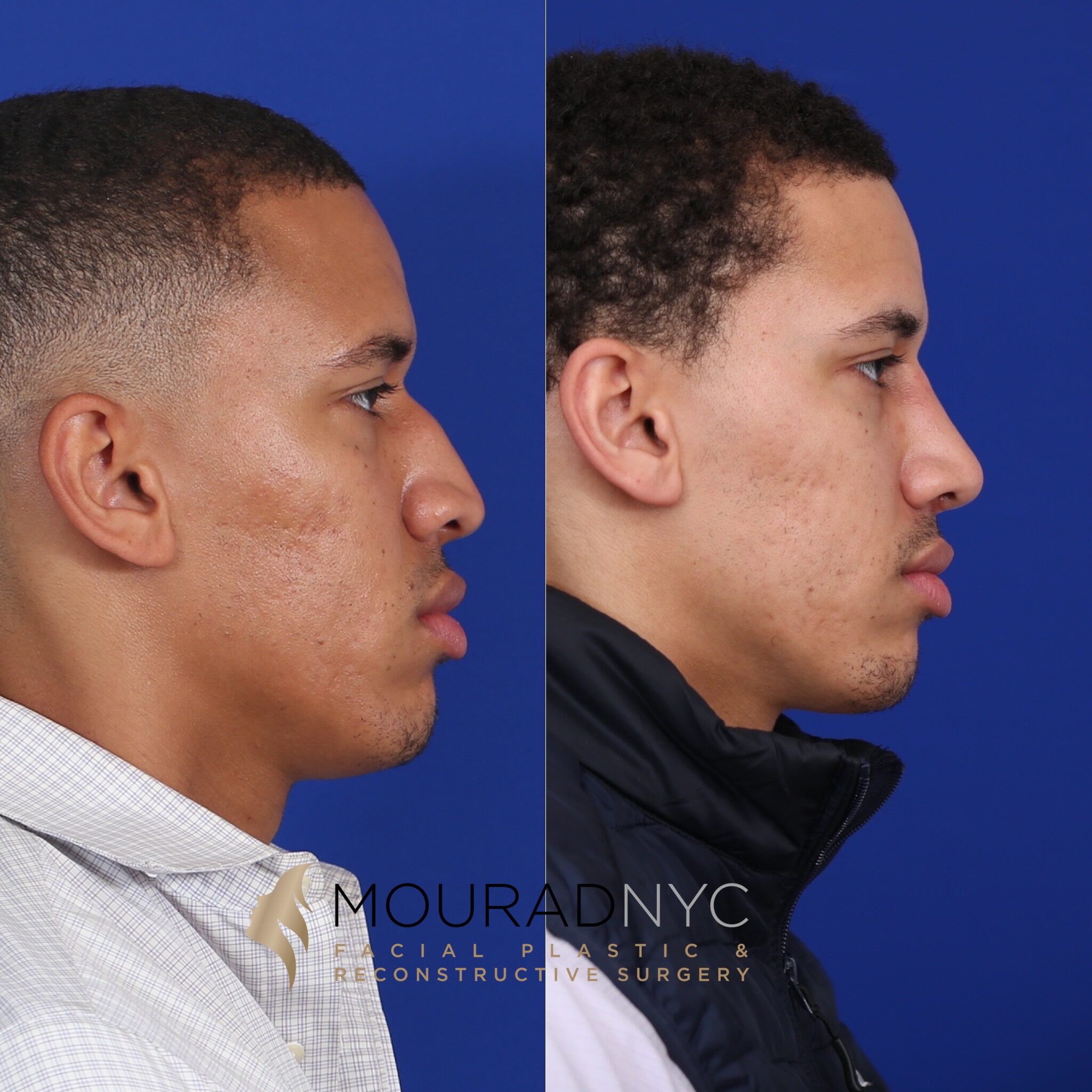 Right lateral profile comparison before and after ethnic rhinoplasty
