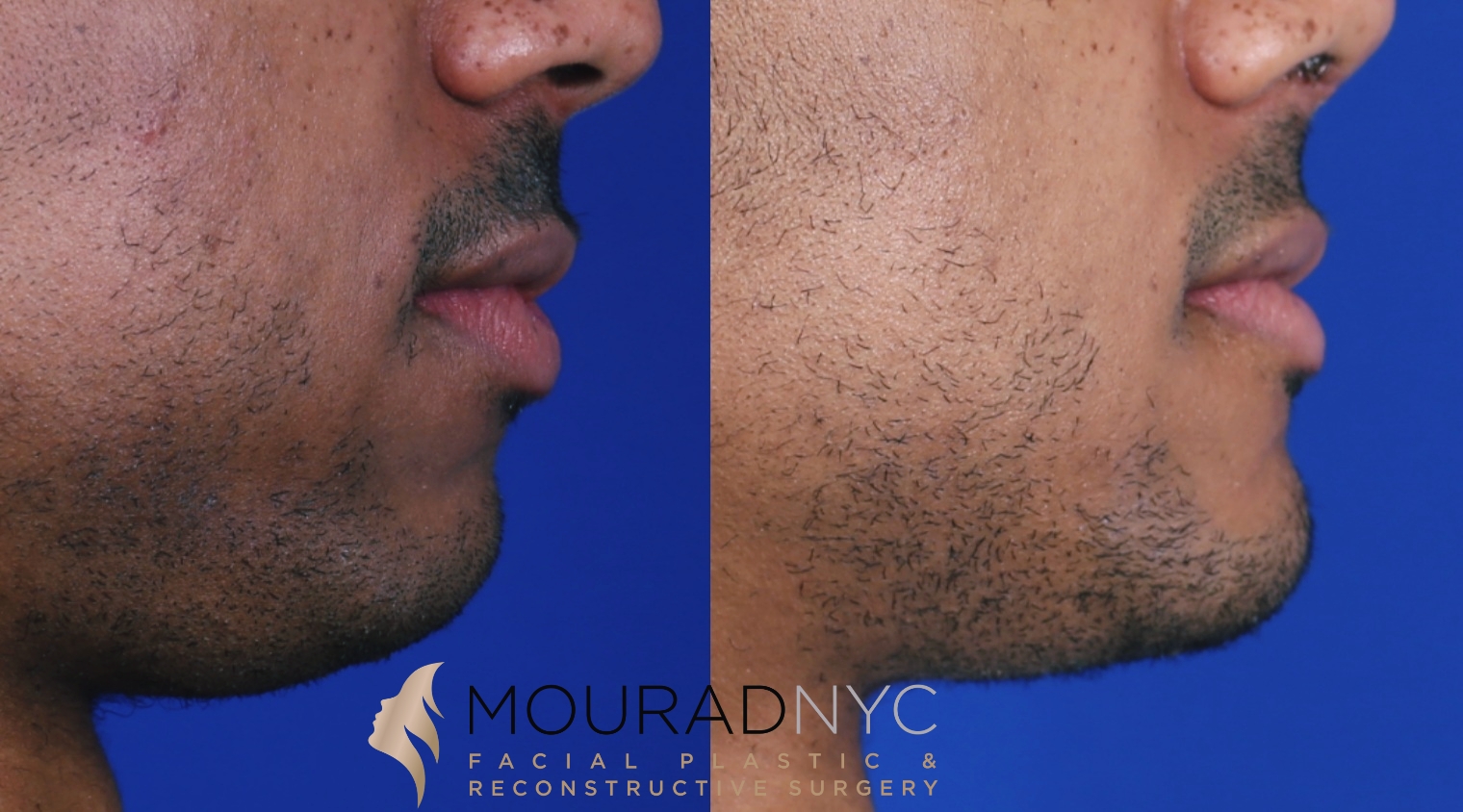 Left lateral close-up comparison of the chin of a male patient in his 20s before and after sliding genioplasty