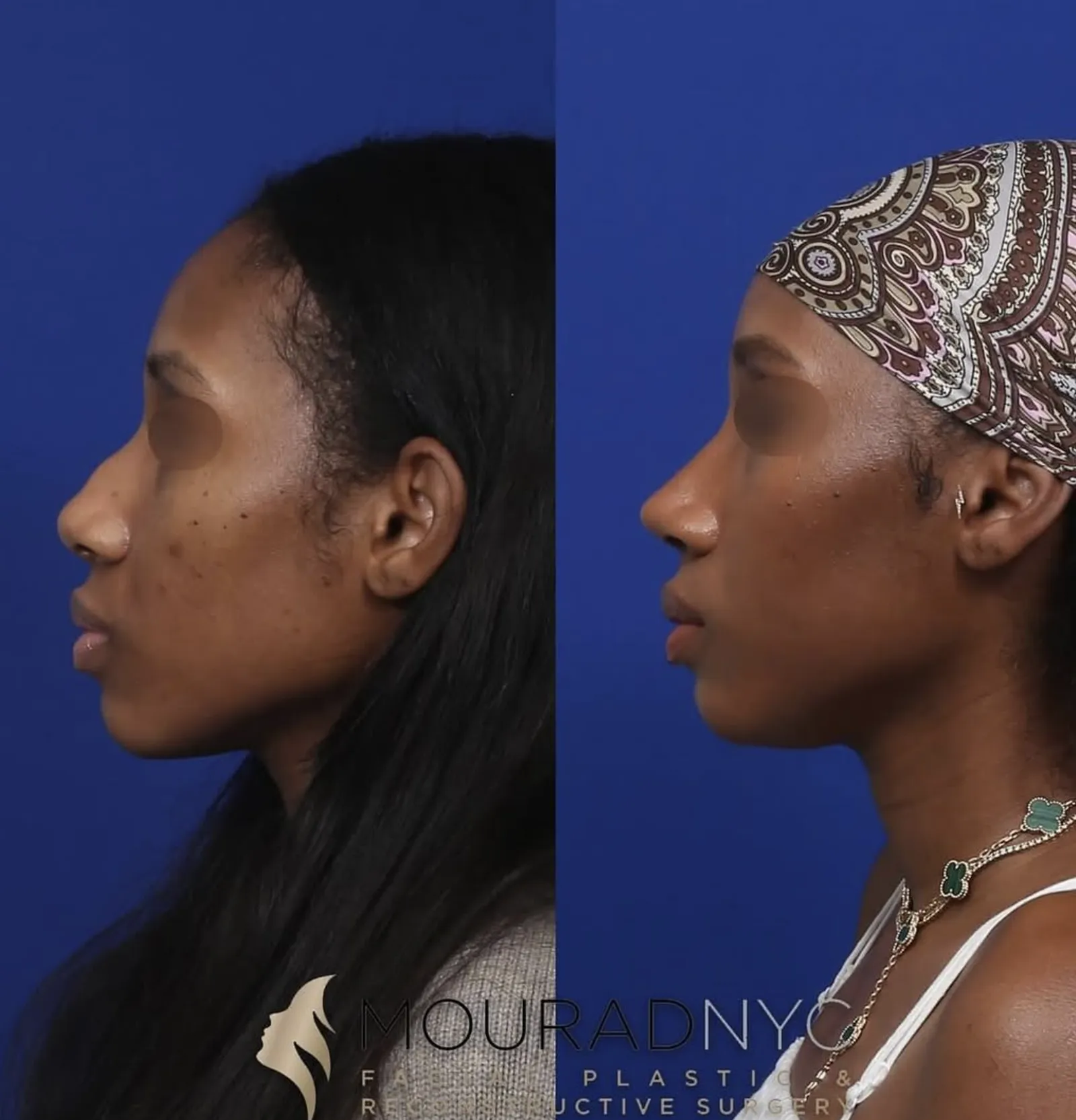 Right lateral profile comparison of a female patient in her 30s before and after ethnic rhinoplasty, sinus surgery, and broken nose repair