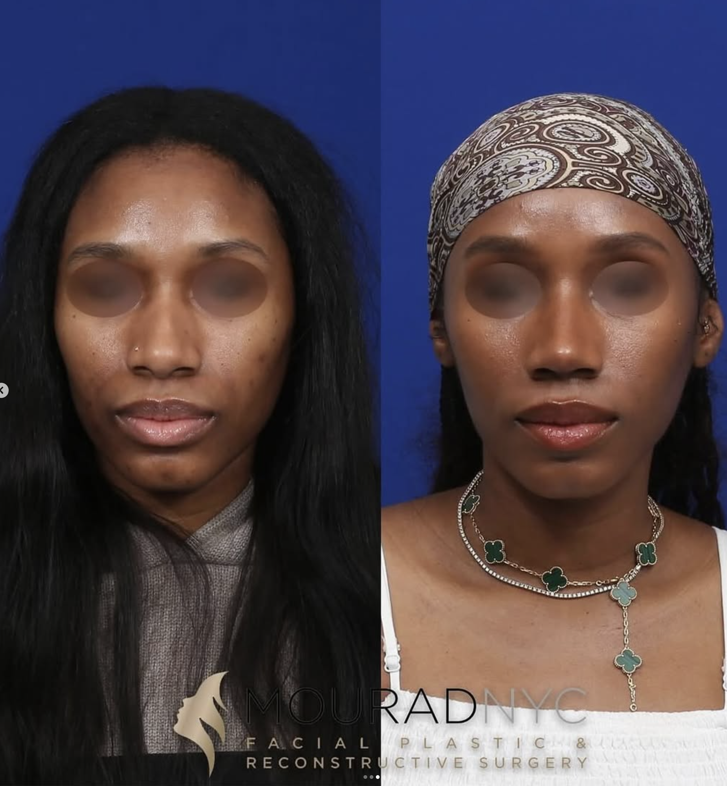 Frontal comparison of a female patient in her 30s before and after ethnic rhinoplasty, sinus surgery, and broken nose repair