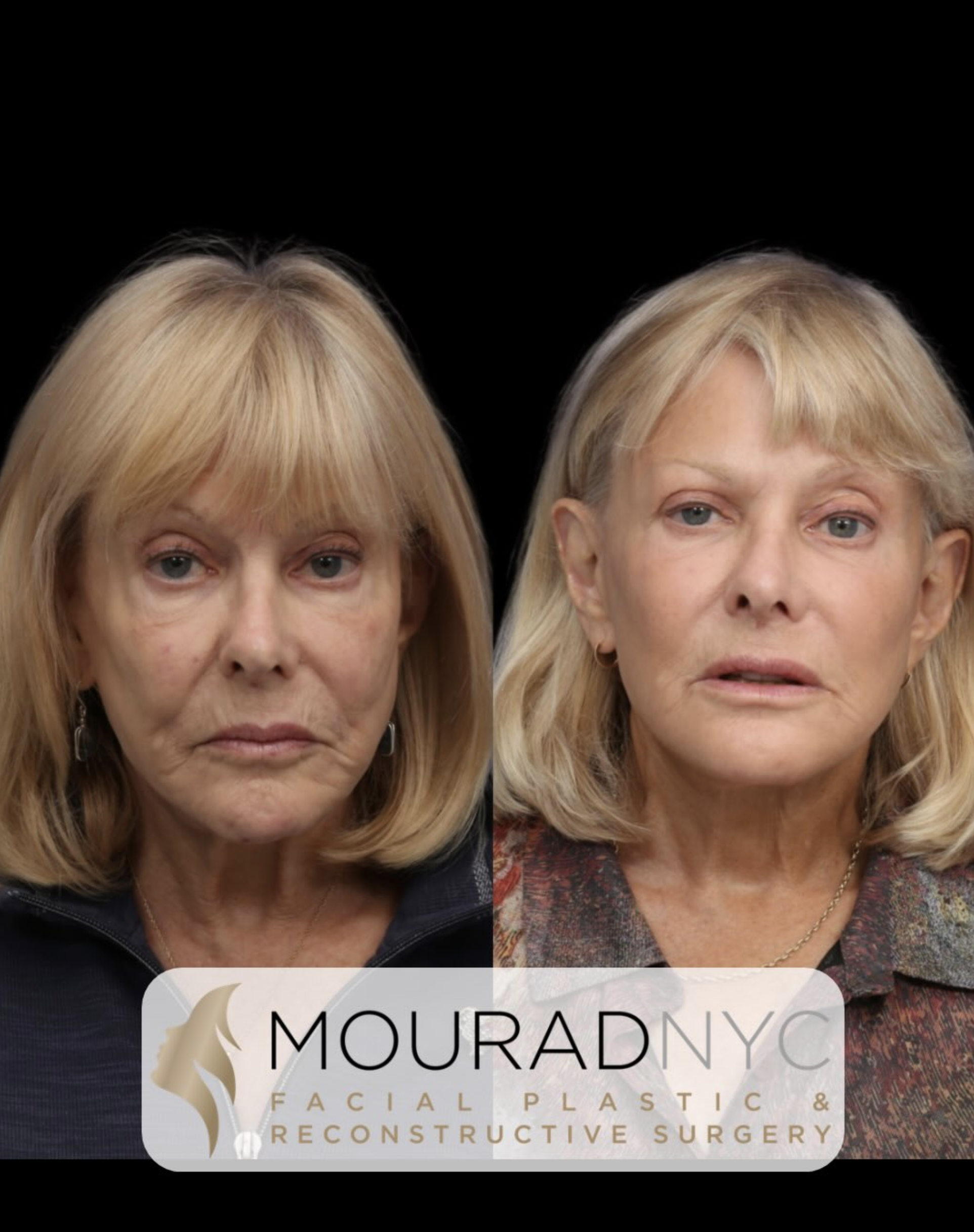 Frontal comparison of a female patient in her 70s before and after revision facelift with neck lift