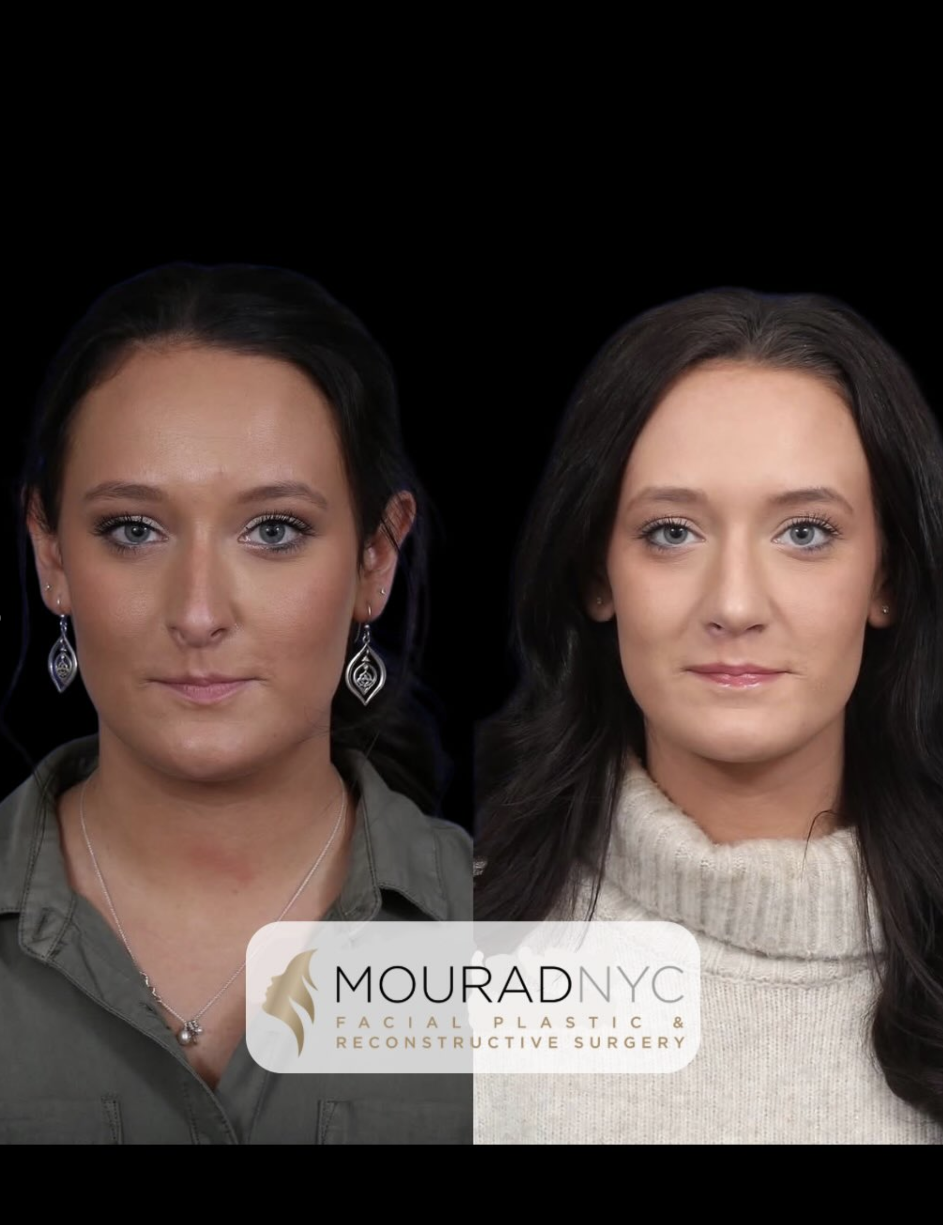 Frontal comparison of a female patient in her 20s before and after revision rhinoplasty with rib graft
