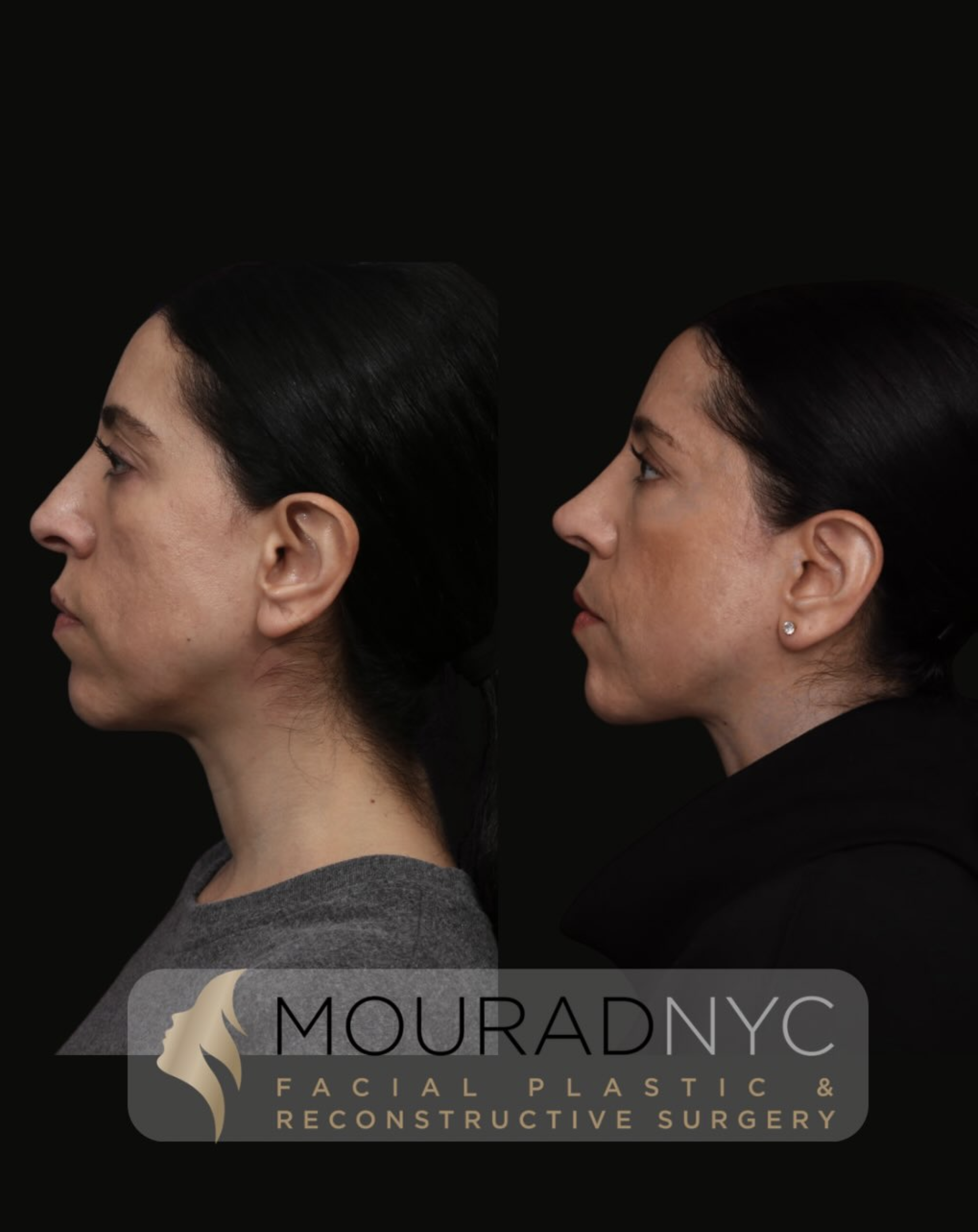 Right lateral profile comparison before and after revision rhinoplasty