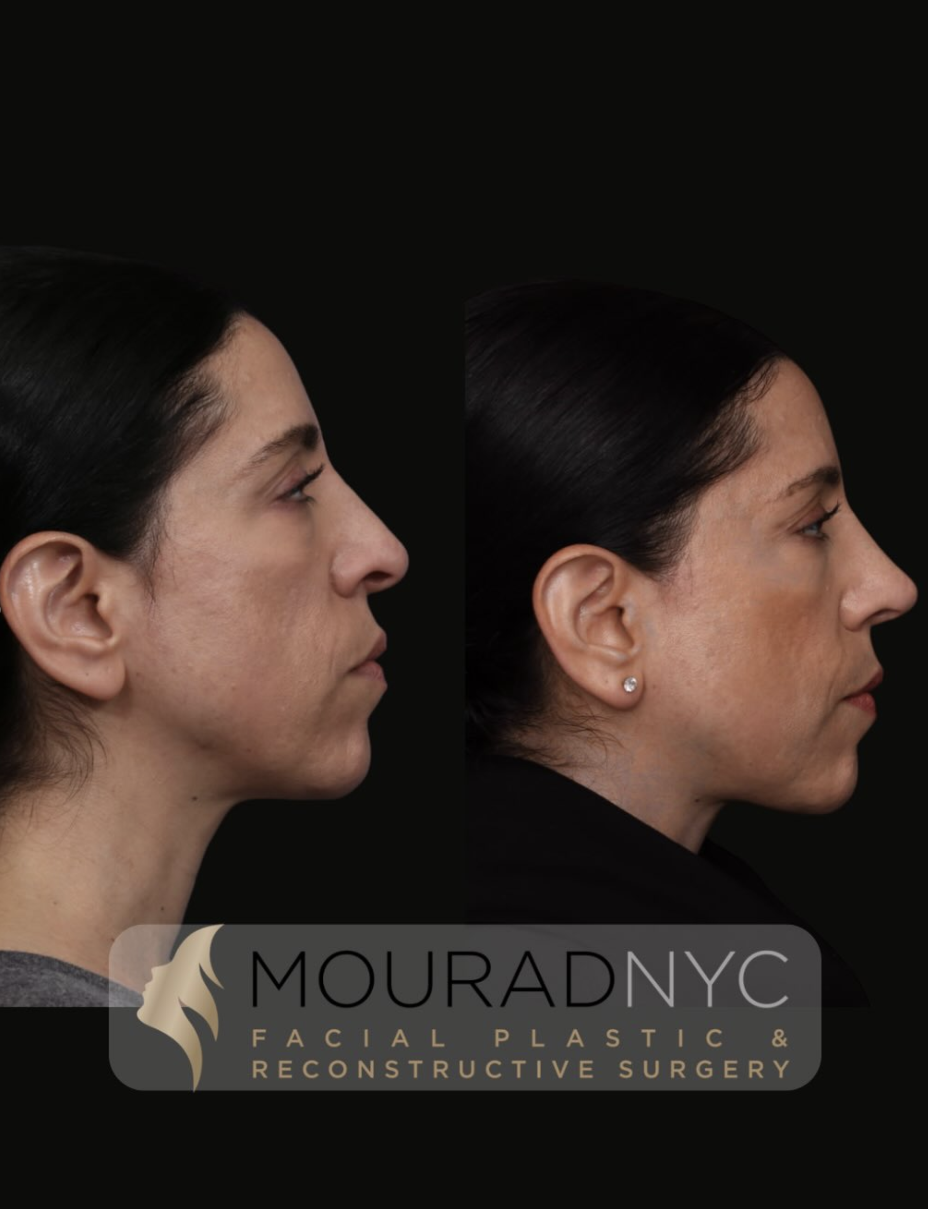 Left lateral profile comparison before and after revision rhinoplasty