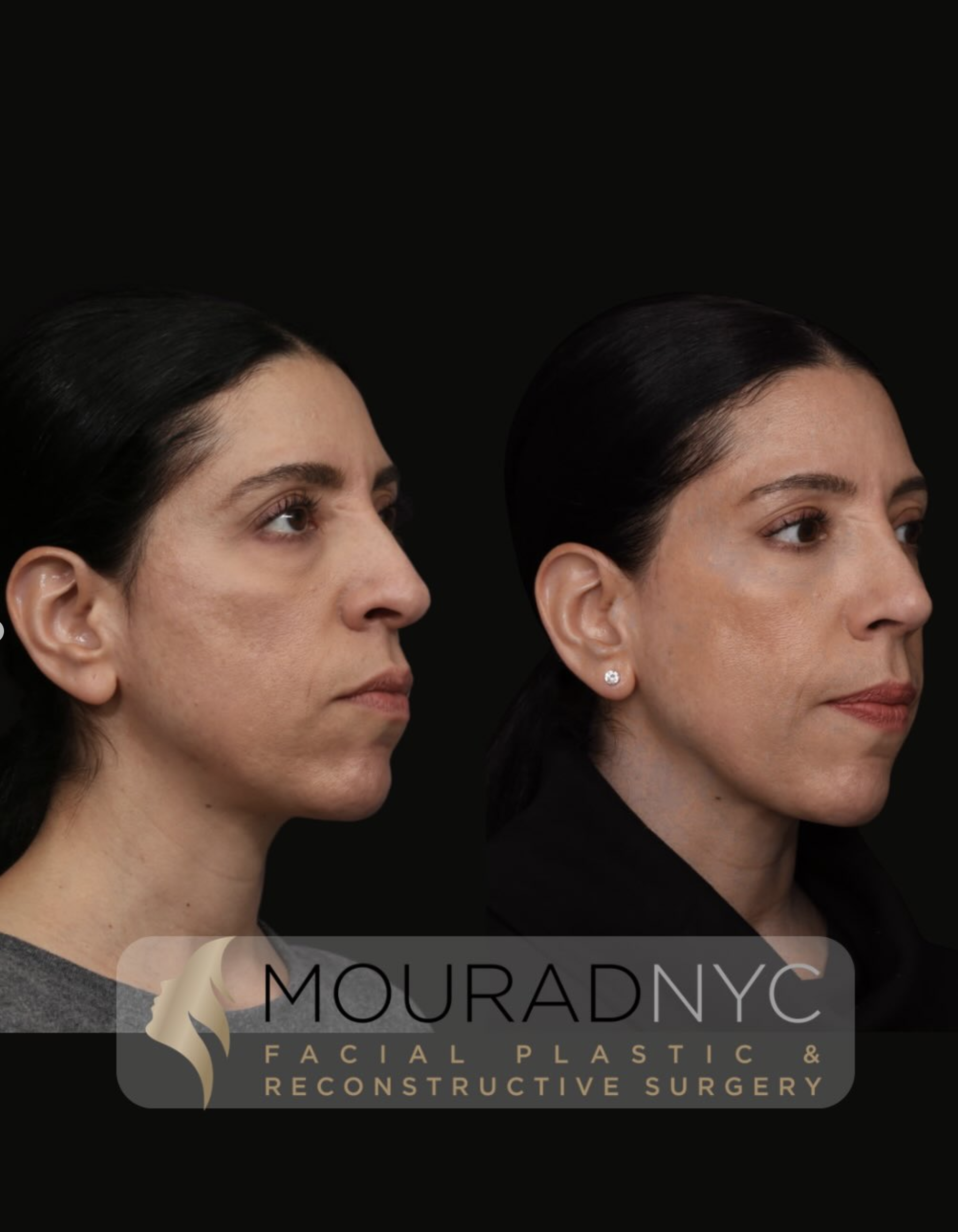 Right oblique comparison before and after revision rhinoplasty