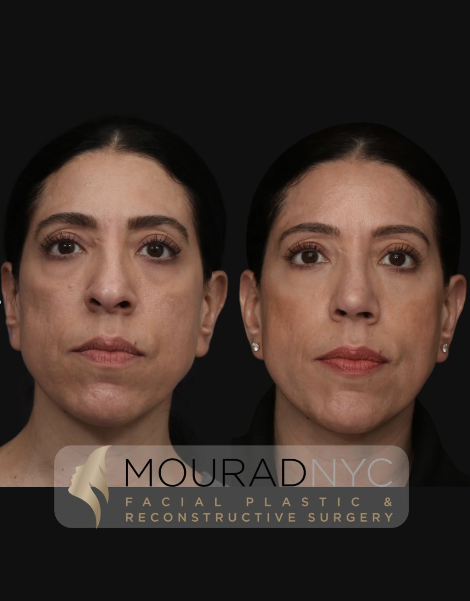 Frontal comparison before and after revision rhinoplasty with rib graft