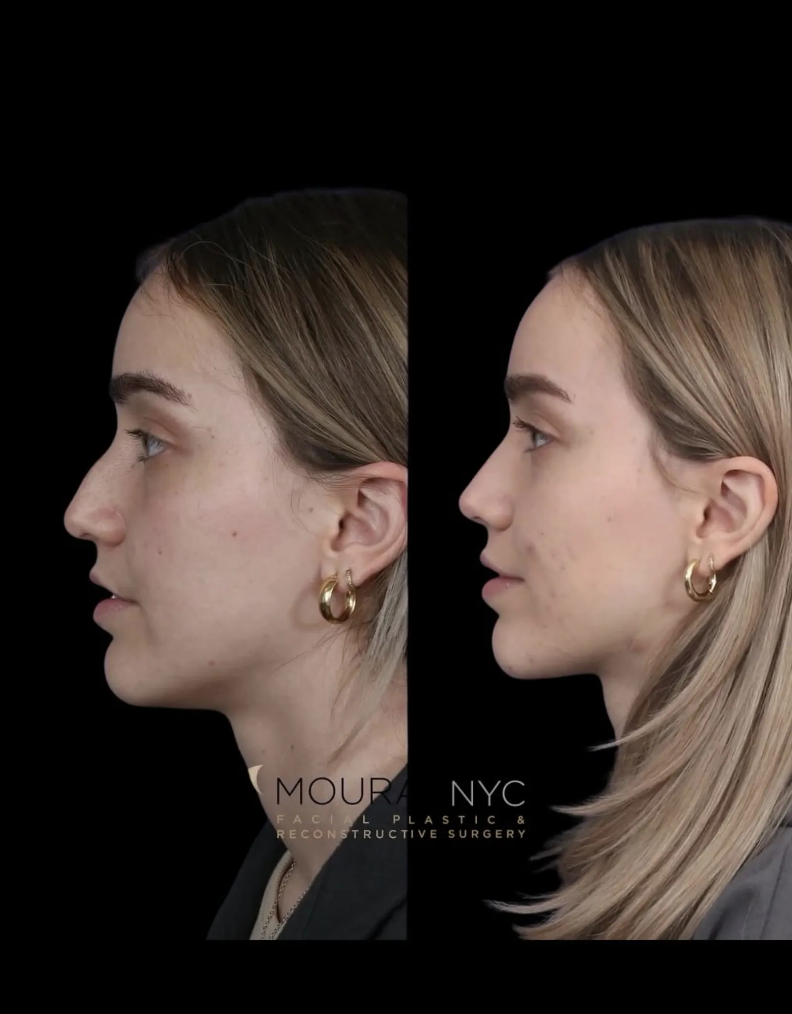 Right lateral profile comparison of a female patient in her 20s before and after primary rhinoplasty