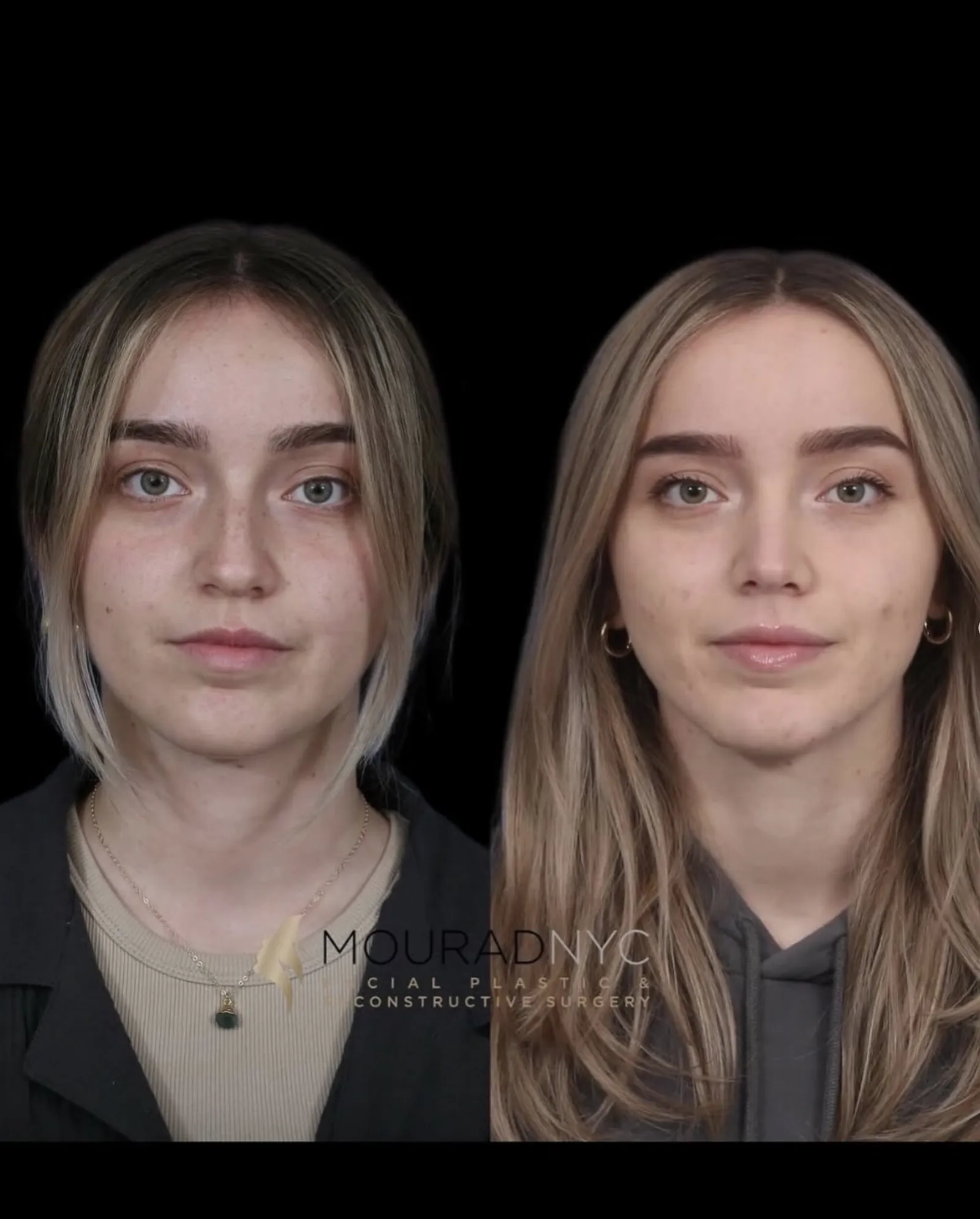 Frontal comparison of a female patient in her 20s before and after primary rhinoplasty