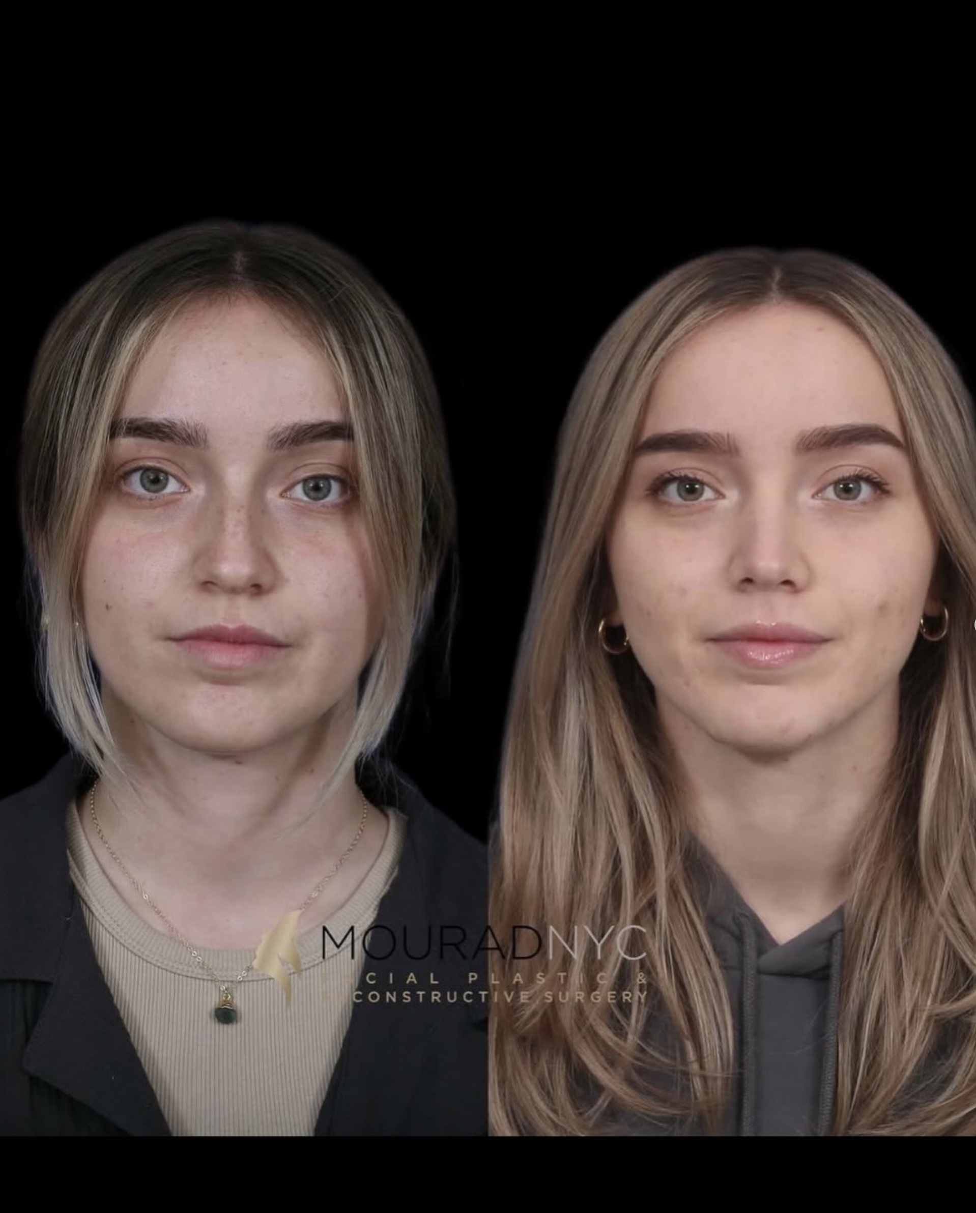 Frontal comparison of a female patient in her 20s before and after primary rhinoplasty