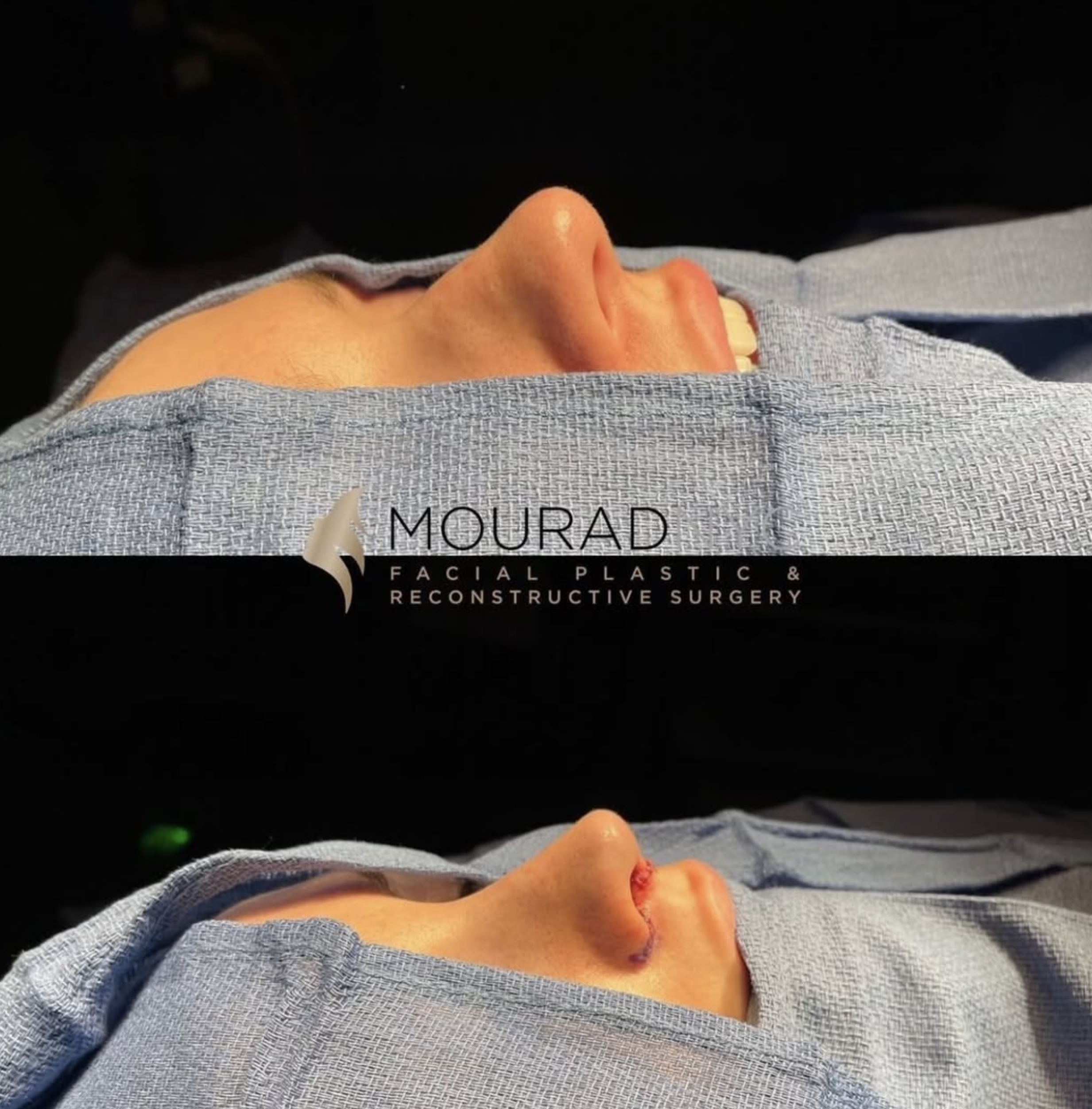 Intra-operative basal view of the nasal base and tip during primary rhinoplasty on a female patient in her 20s