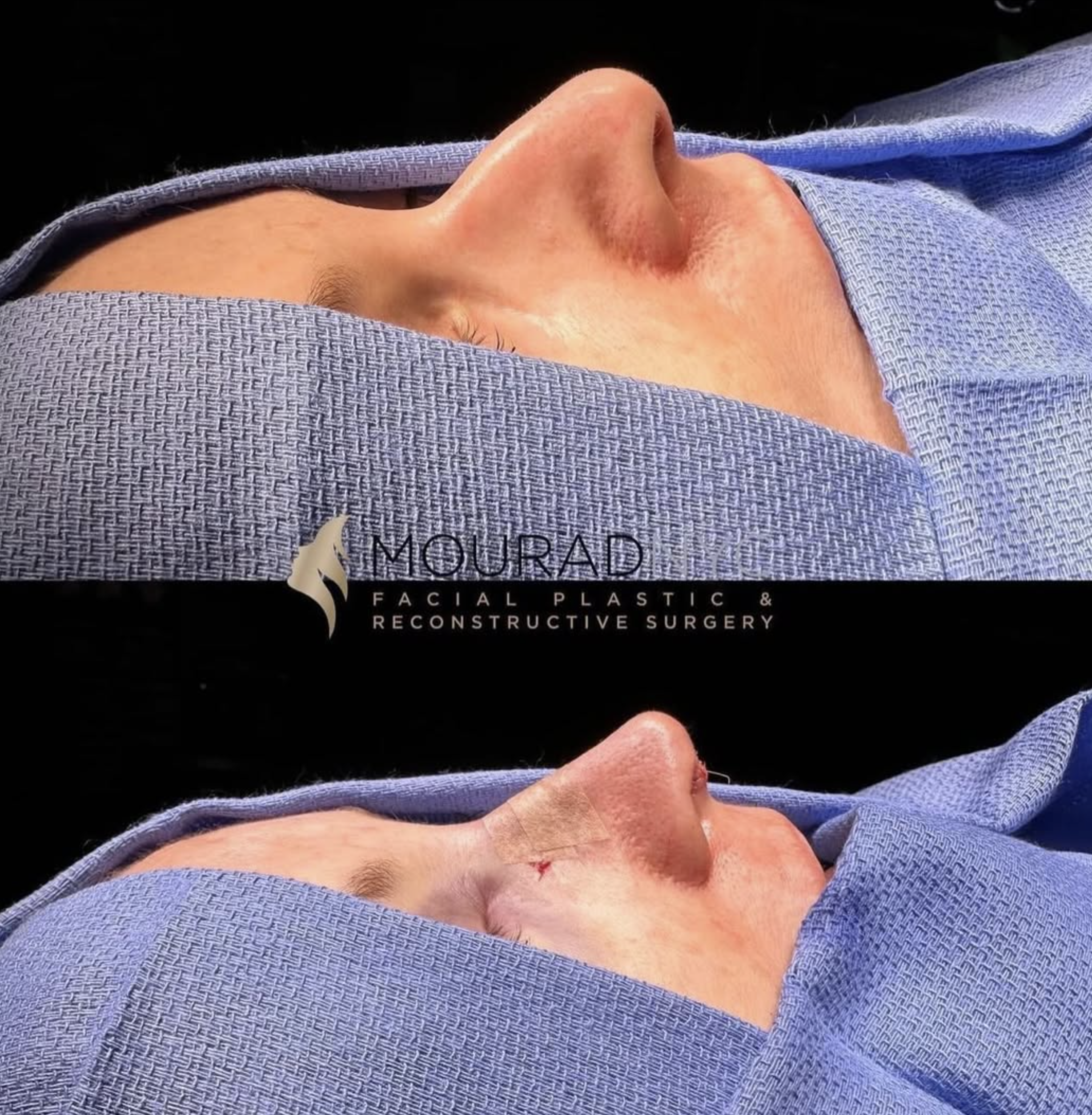 Intra-operative basal view of the nasal base and tip during primary rhinoplasty on a female patient in her 50s