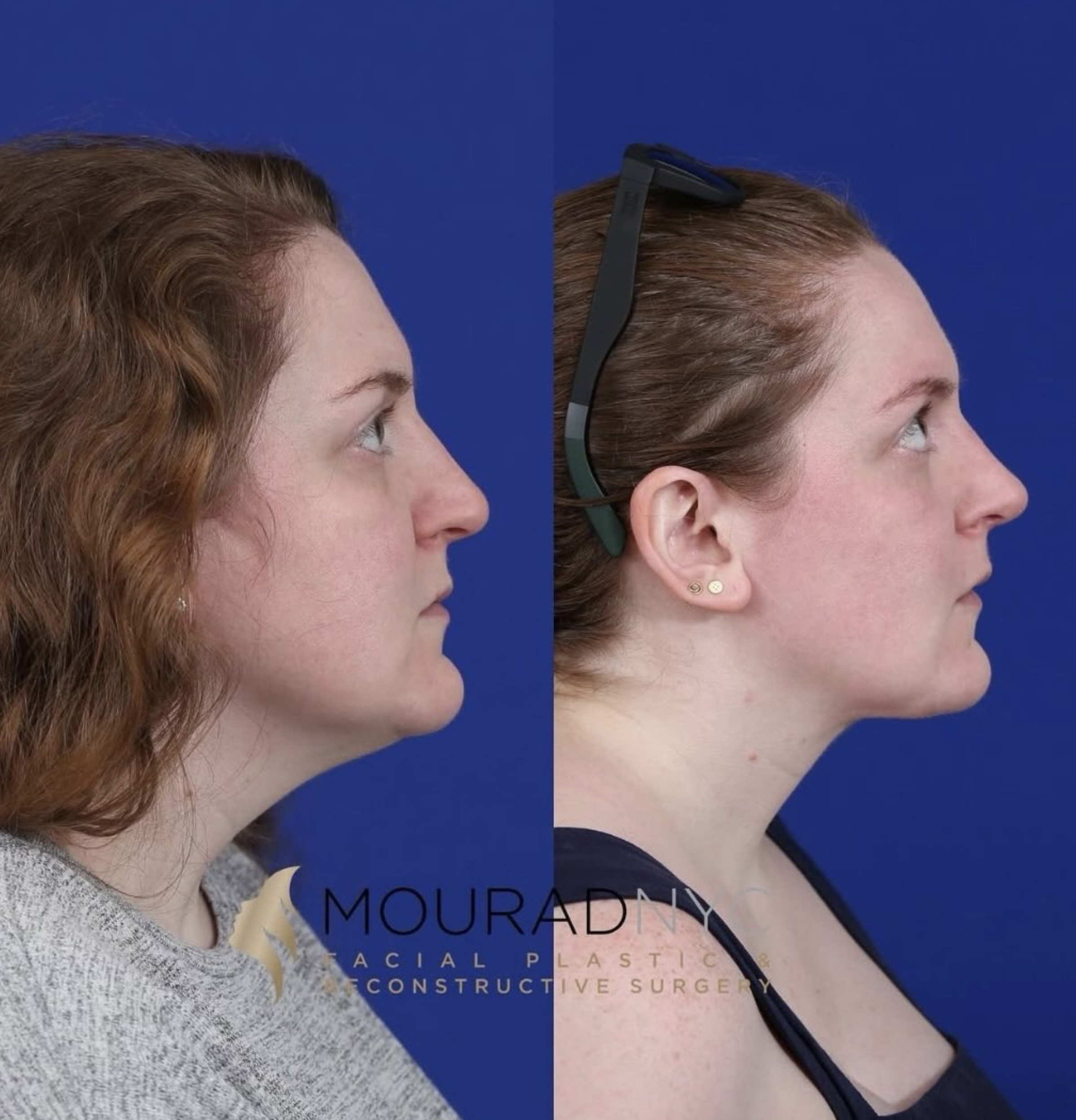 Lateral profile comparison of a female patient in her 30s before and after primary rhinoplasty and neck lift