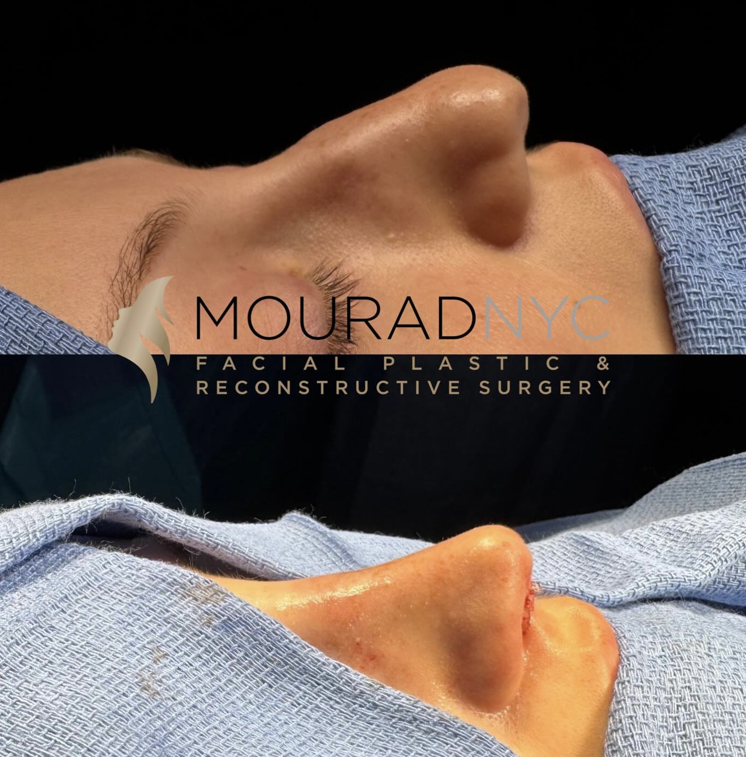Intra-operative basal view of the nasal base and tip during primary rhinoplasty on a female patient in her 20s