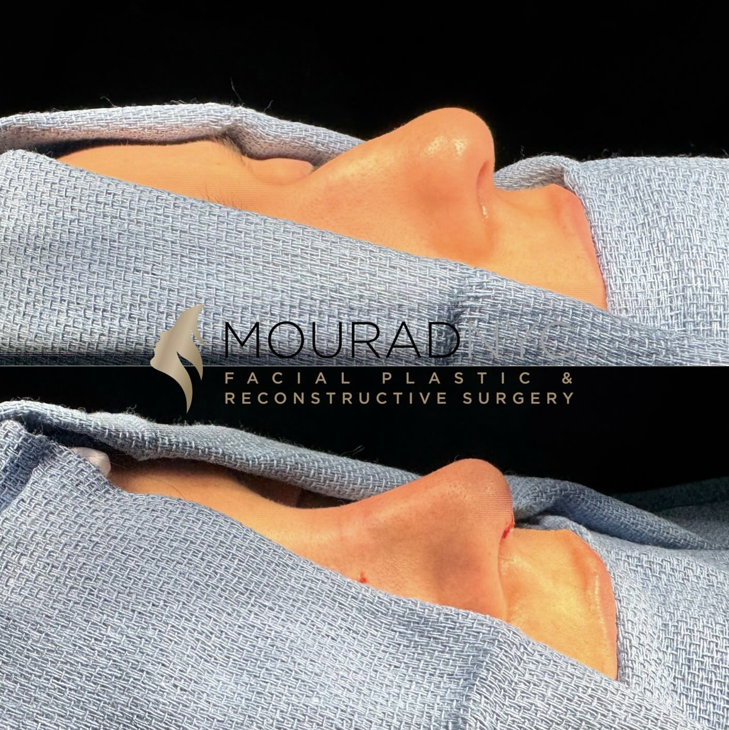 Intra-operative basal view of the nasal base and tip during primary rhinoplasty on a female patient in her 20s