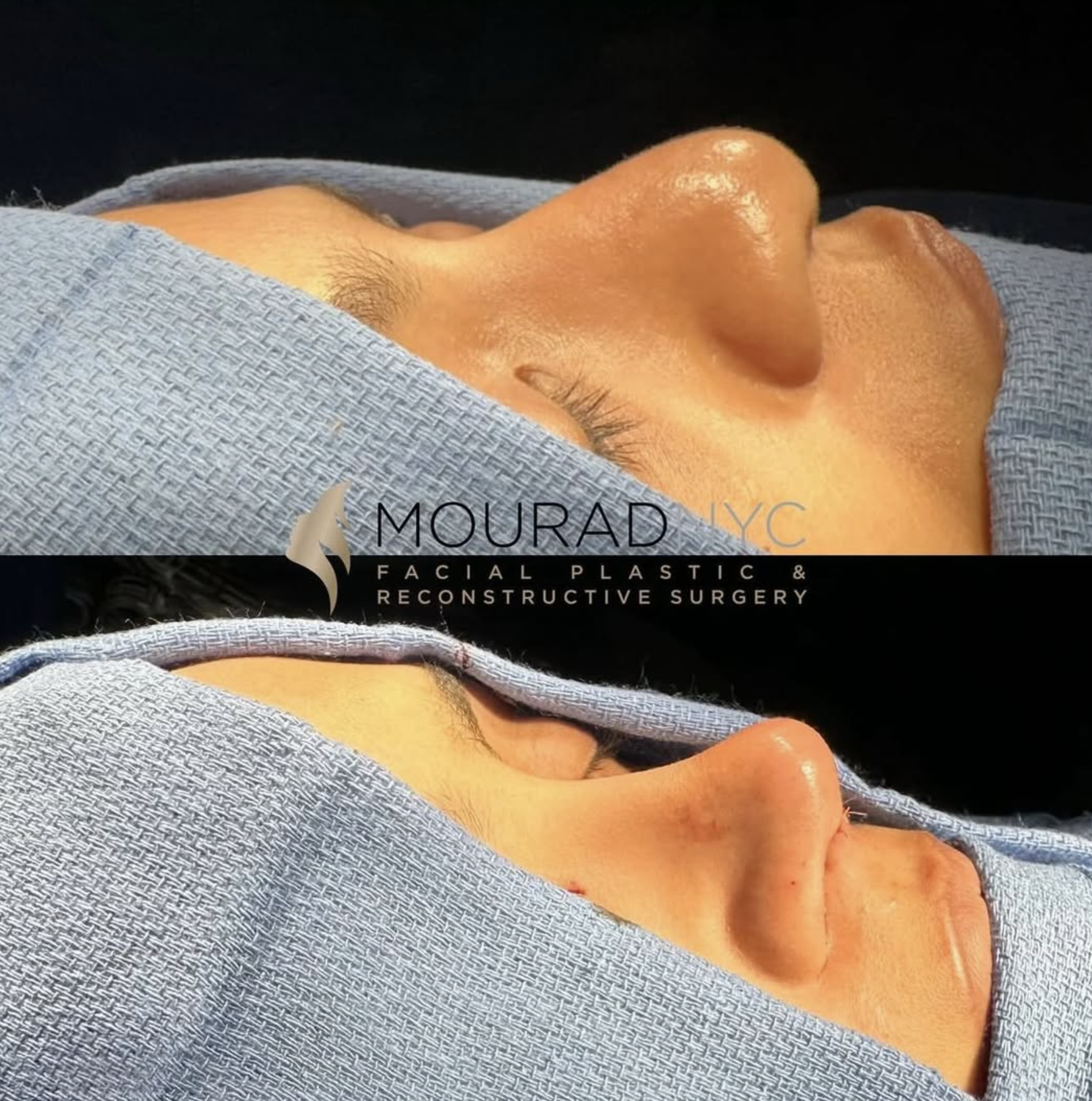 Intra-operative basal view of the nasal base and tip during revision rhinoplasty on a female patient in her 30s
