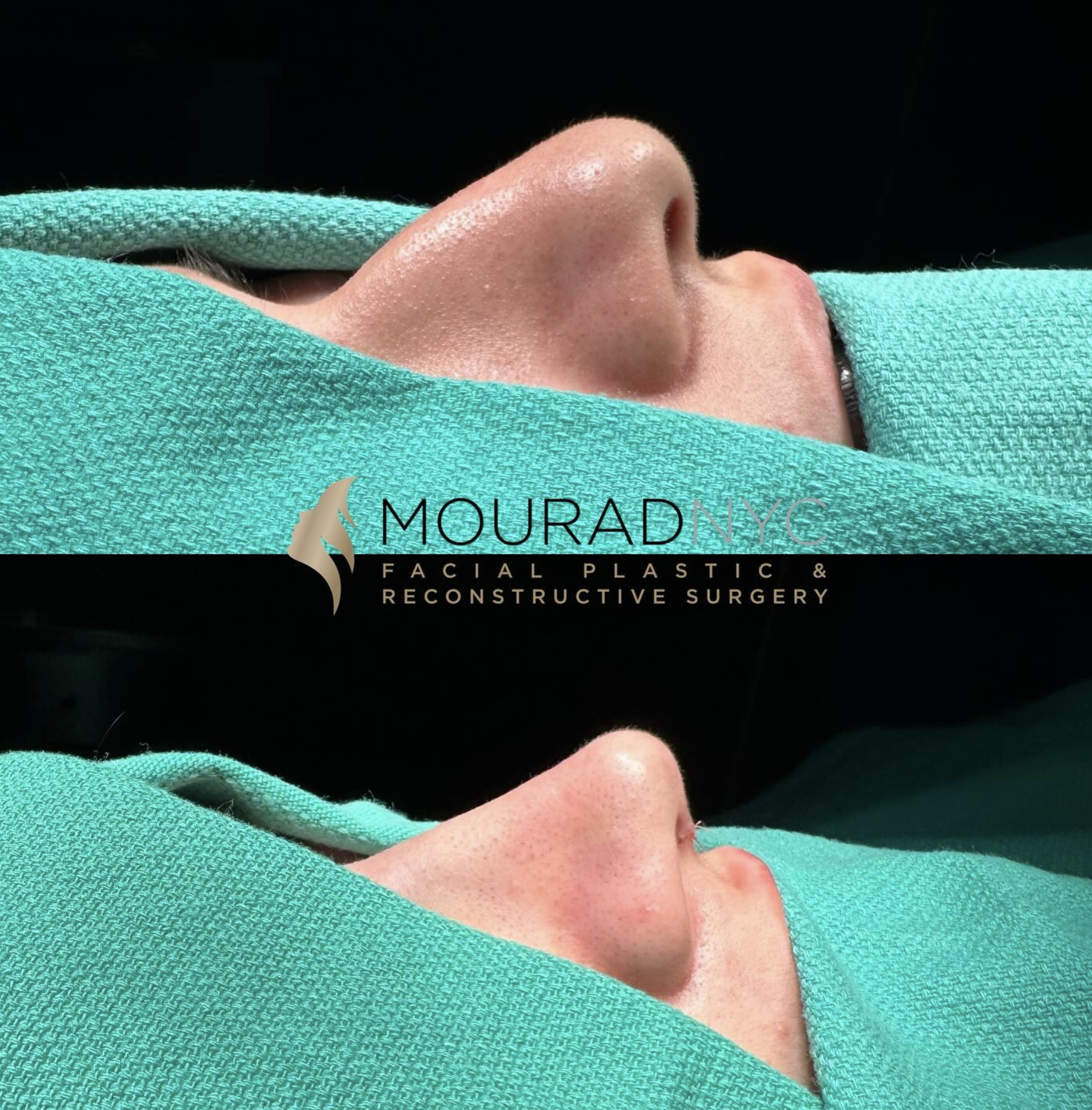 Intra-operative basal view of the nasal base and tip during primary rhinoplasty on a female patient in her 20s