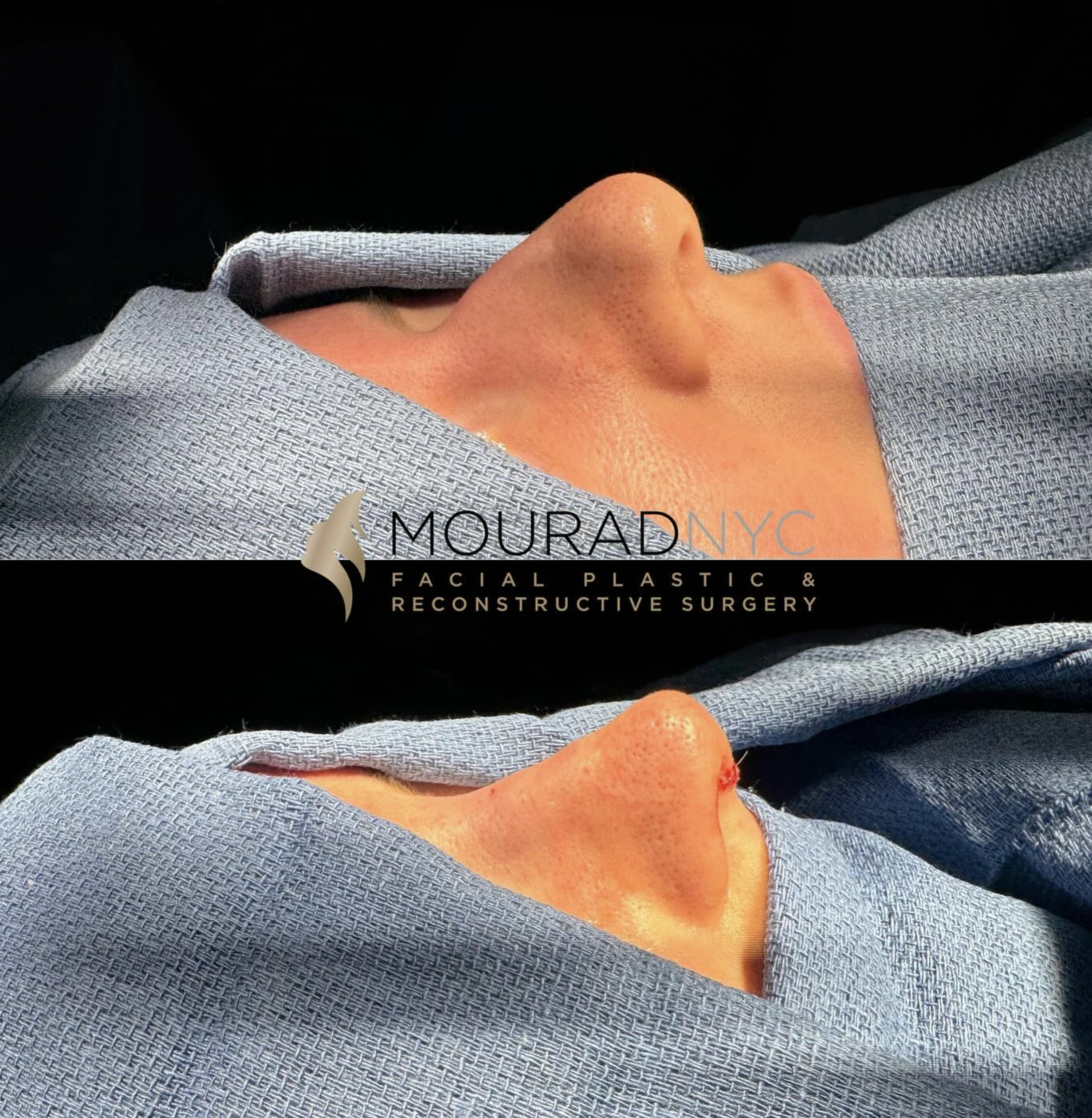Intra-operative basal view of the nasal base and tip during primary rhinoplasty on a female patient in her 20s