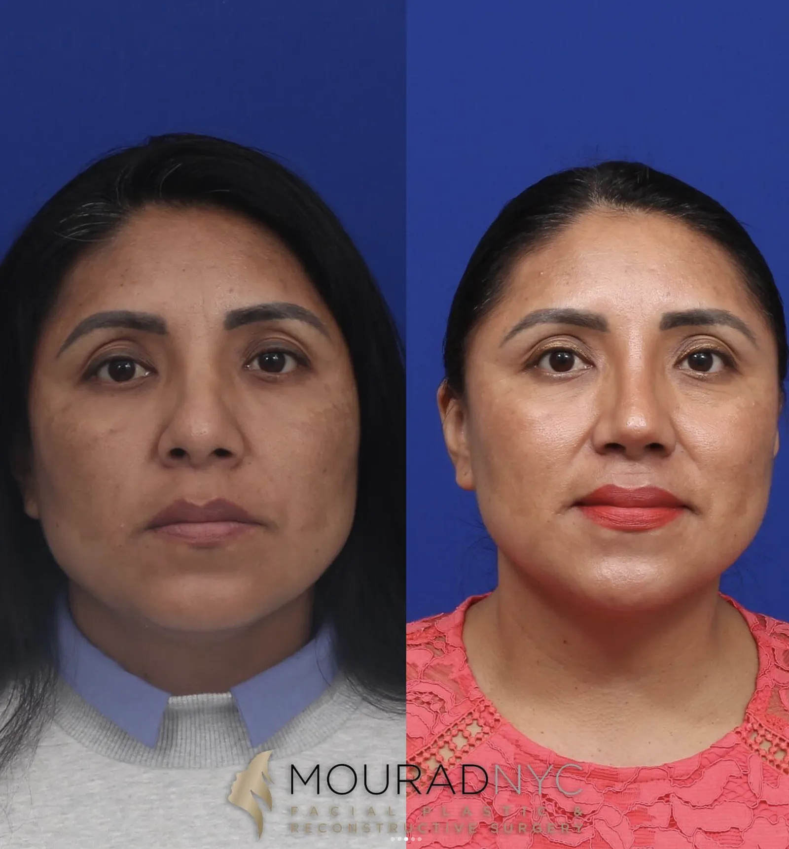 Frontal comparison of a female patient in her 40s before and after revision rhinoplasty with rib graft