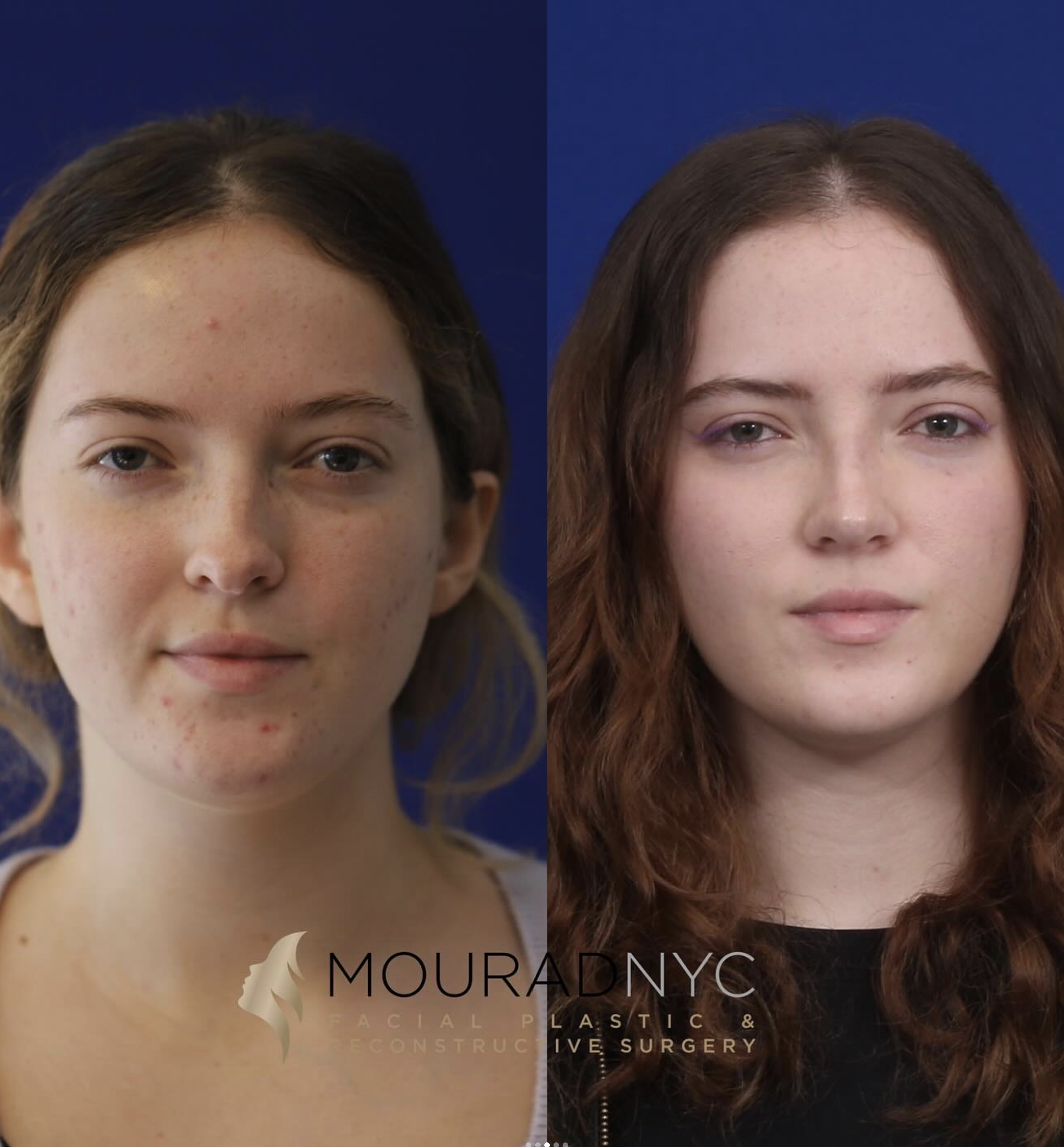 Frontal comparison of a female patient in her 20s before and after primary rhinoplasty