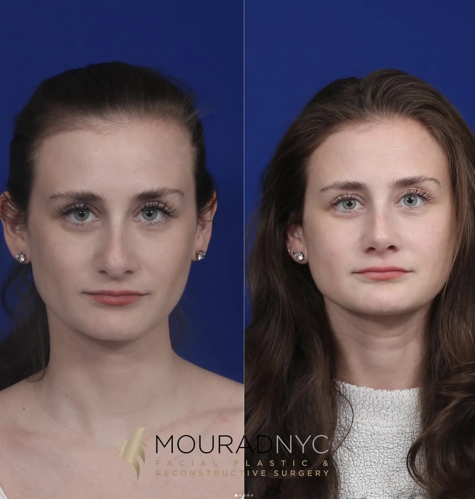Frontal comparison of a female patient in her 20s before and after primary rhinoplasty